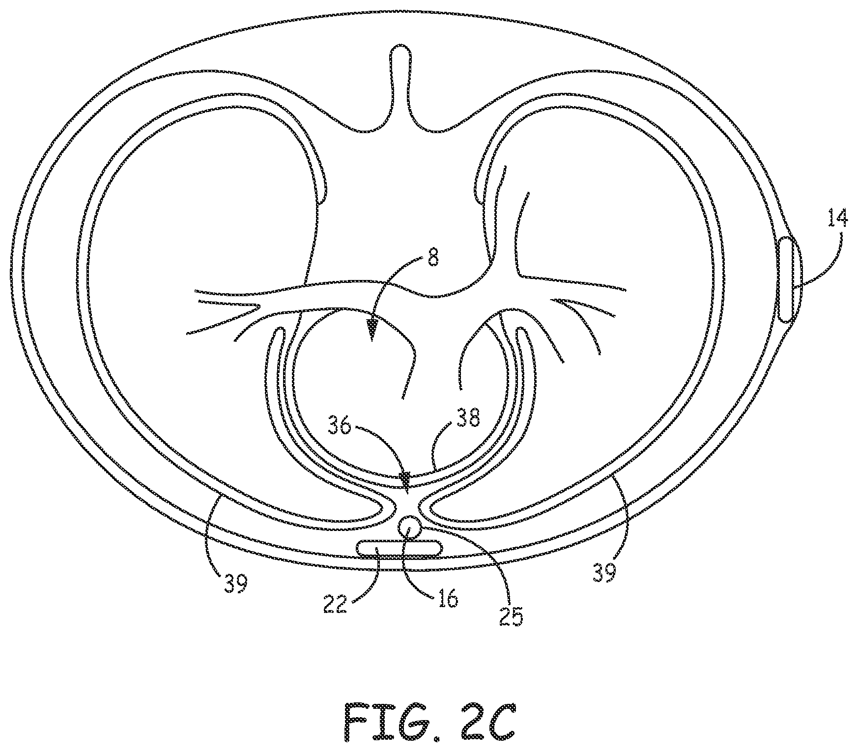 Patent US12311189 Figure 5 – Multi-threshold sensing of cardiac electrical signals in an extracardiovascular implantable cardioverter defibrillator