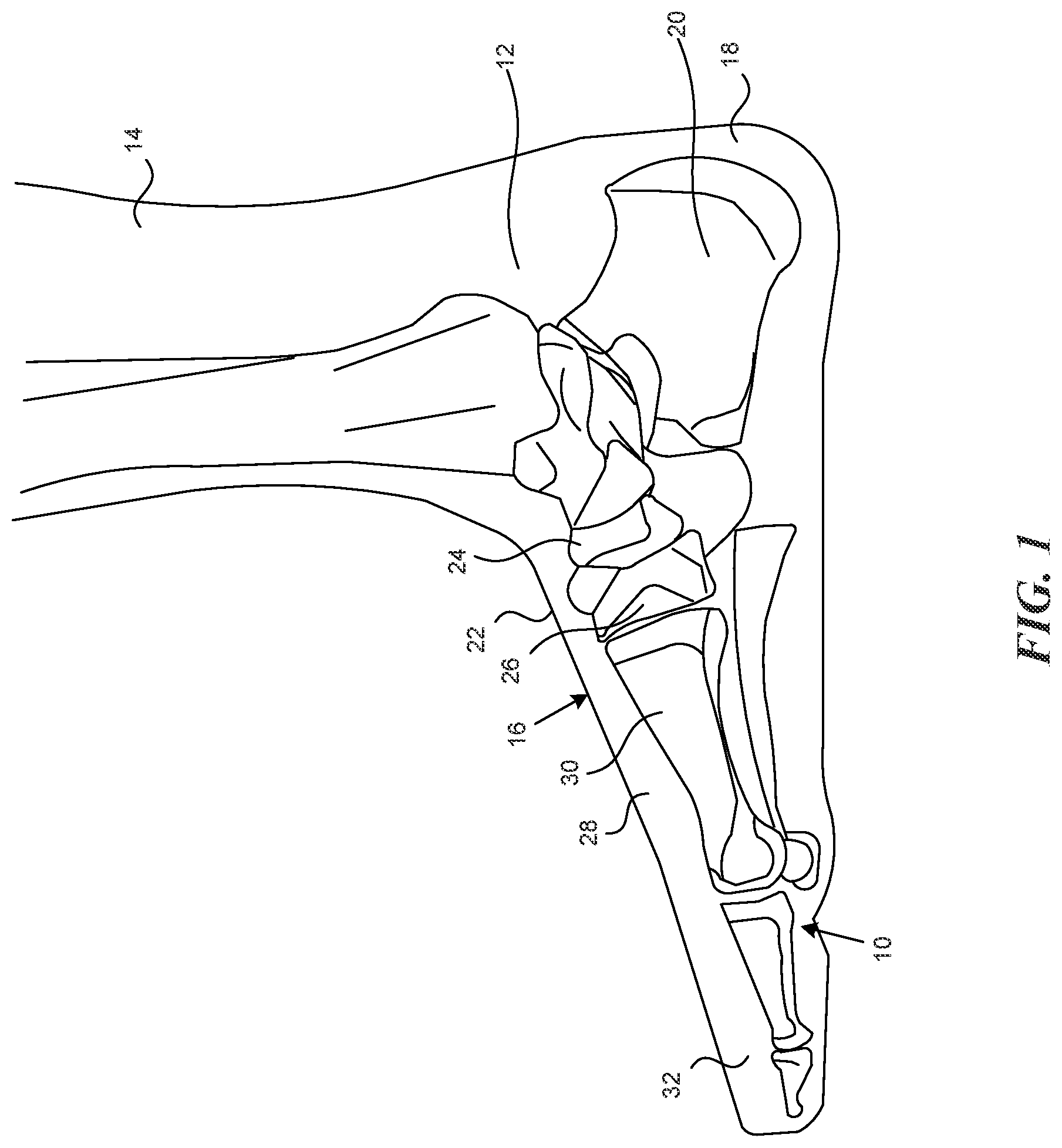 Patent US12317955 — Personalized footwear with integrated caging system — Figure 1