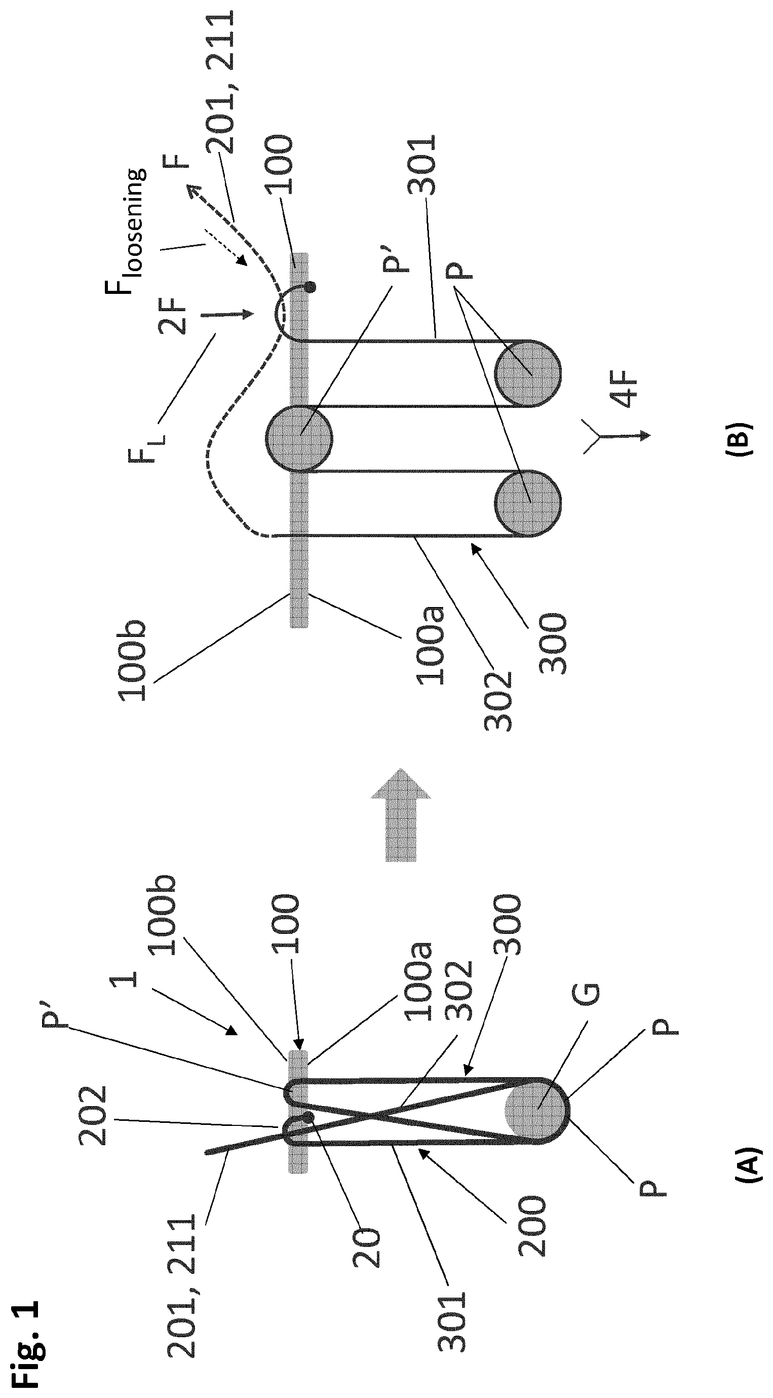 Patent US12318083 — Single strand self-locking suspension device for medical use — Figure 1
