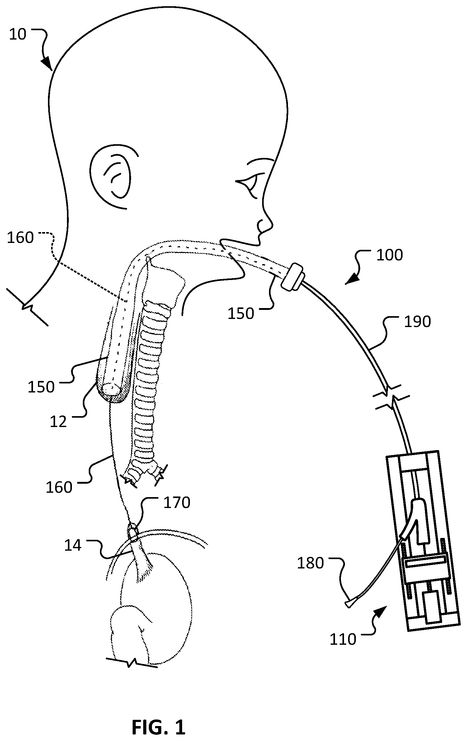 Patent US12318084 — Medical devices and methods for body conduit lengthening and anastomosis formation — Figure 1