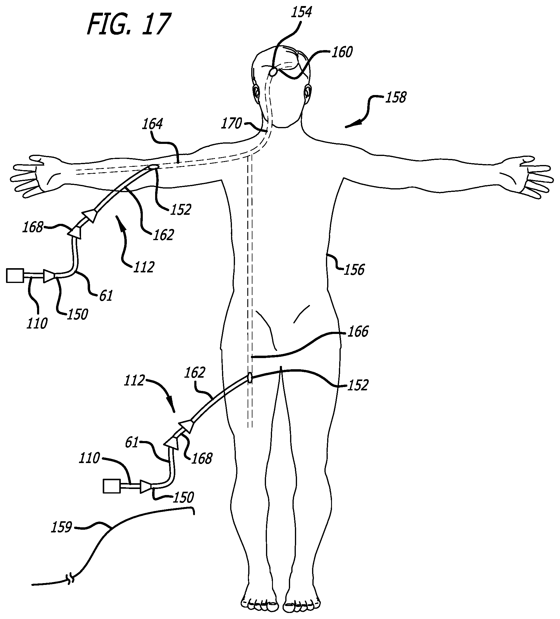 Patent US12318091 Figure 12 – Filamentary devices for treatment of vascular defects