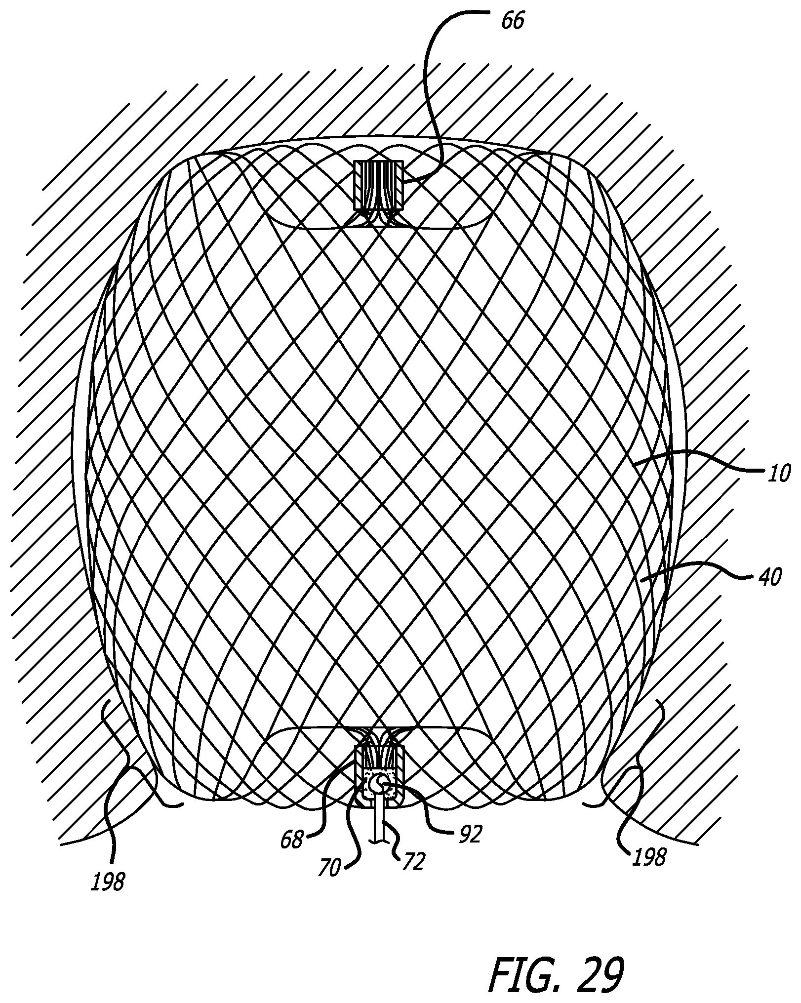 Patent US12318091 Figure 17 – Filamentary devices for treatment of vascular defects