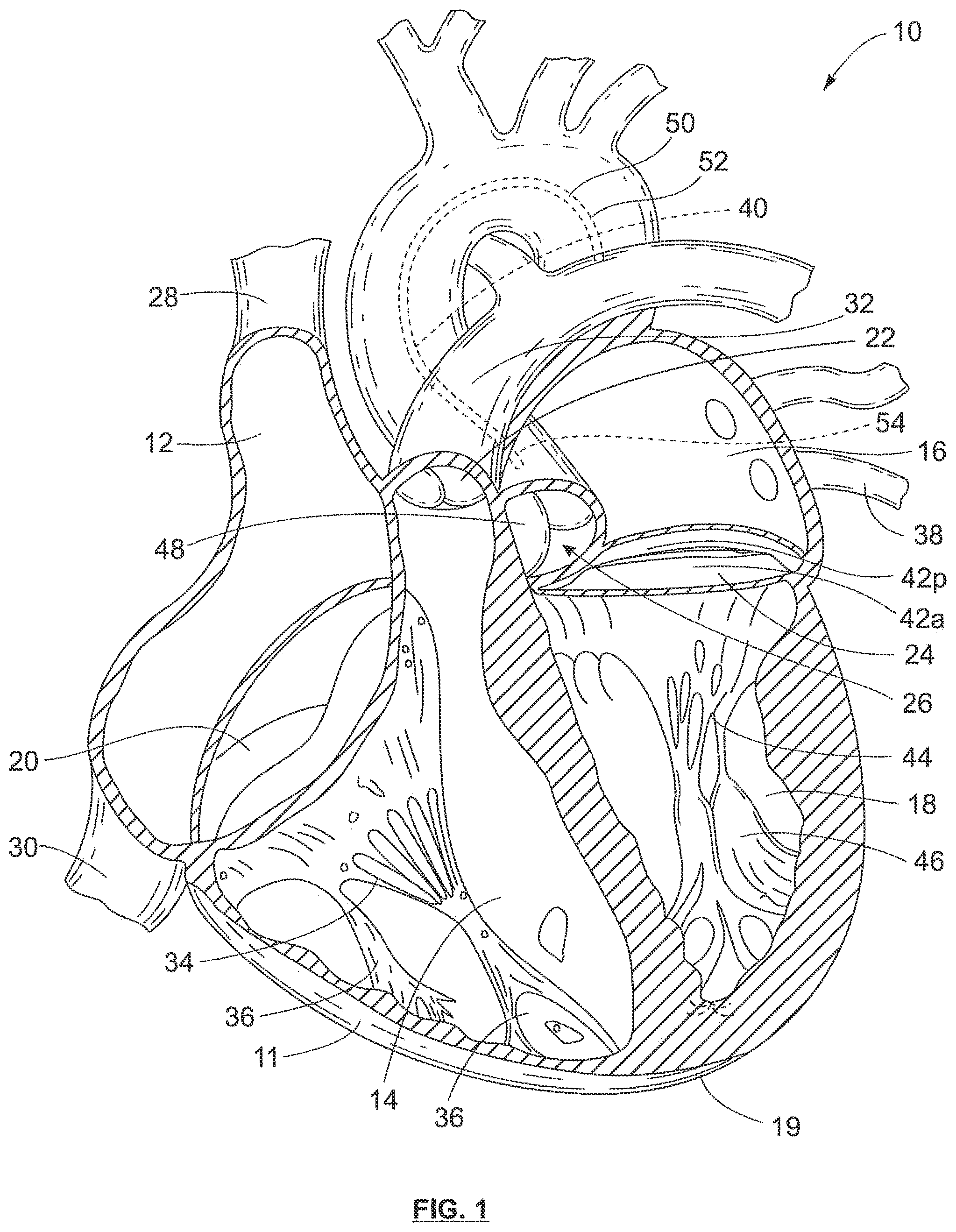 Patent US12318105 — Biscuspid valve dissection device — Figure 1