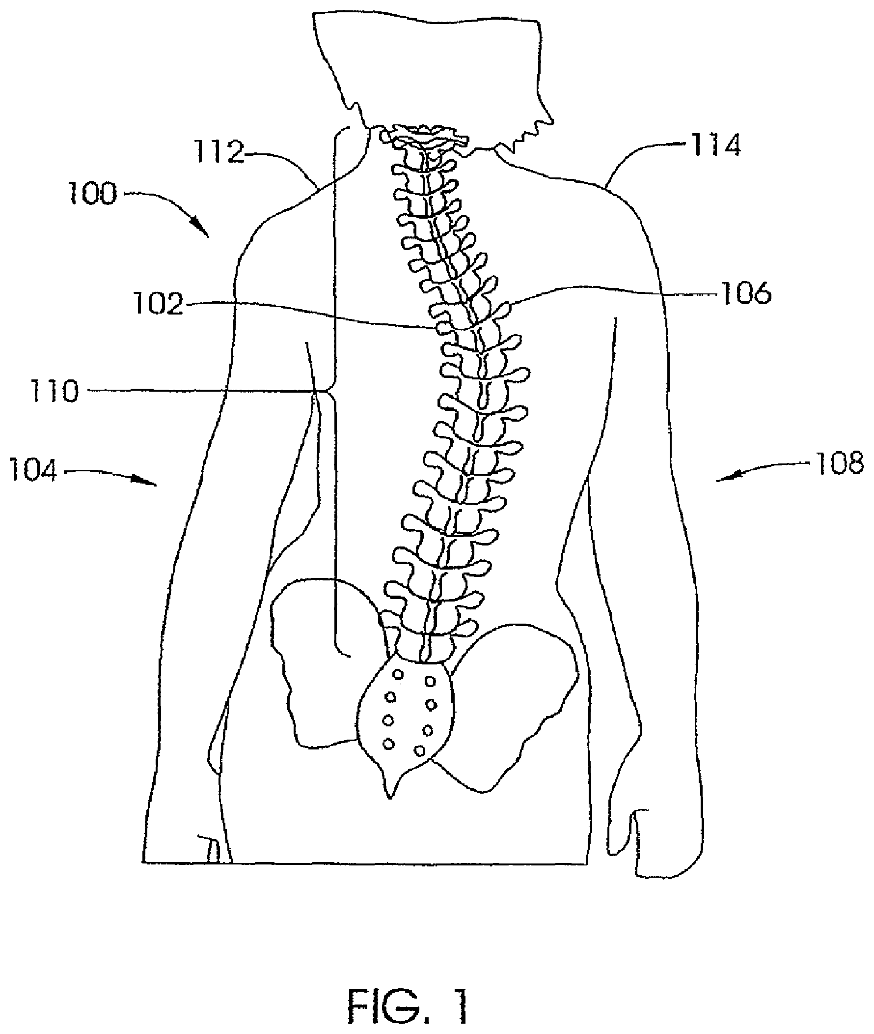 Patent US12318119 — Adjustable implant system — Figure 1