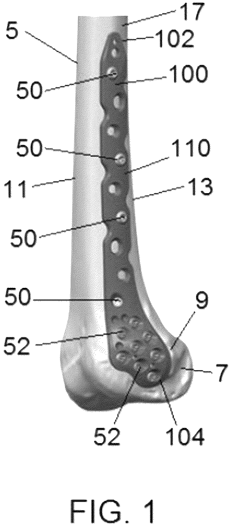 Patent US12318122 — Bone stabilization systems — Figure 1