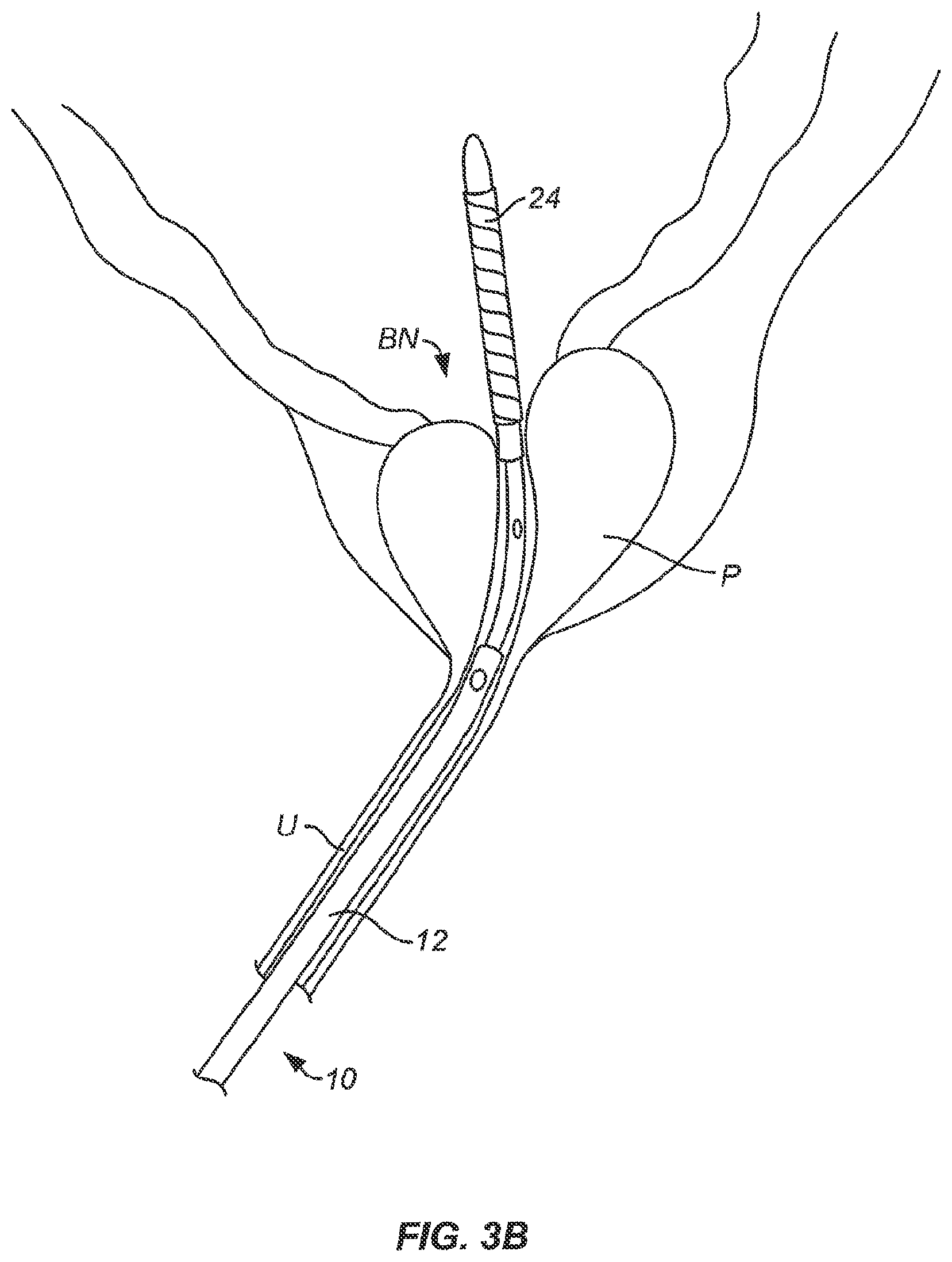 Patent US12318137 Figure 4 – Controlled tissue treatment with energy and control circuitry