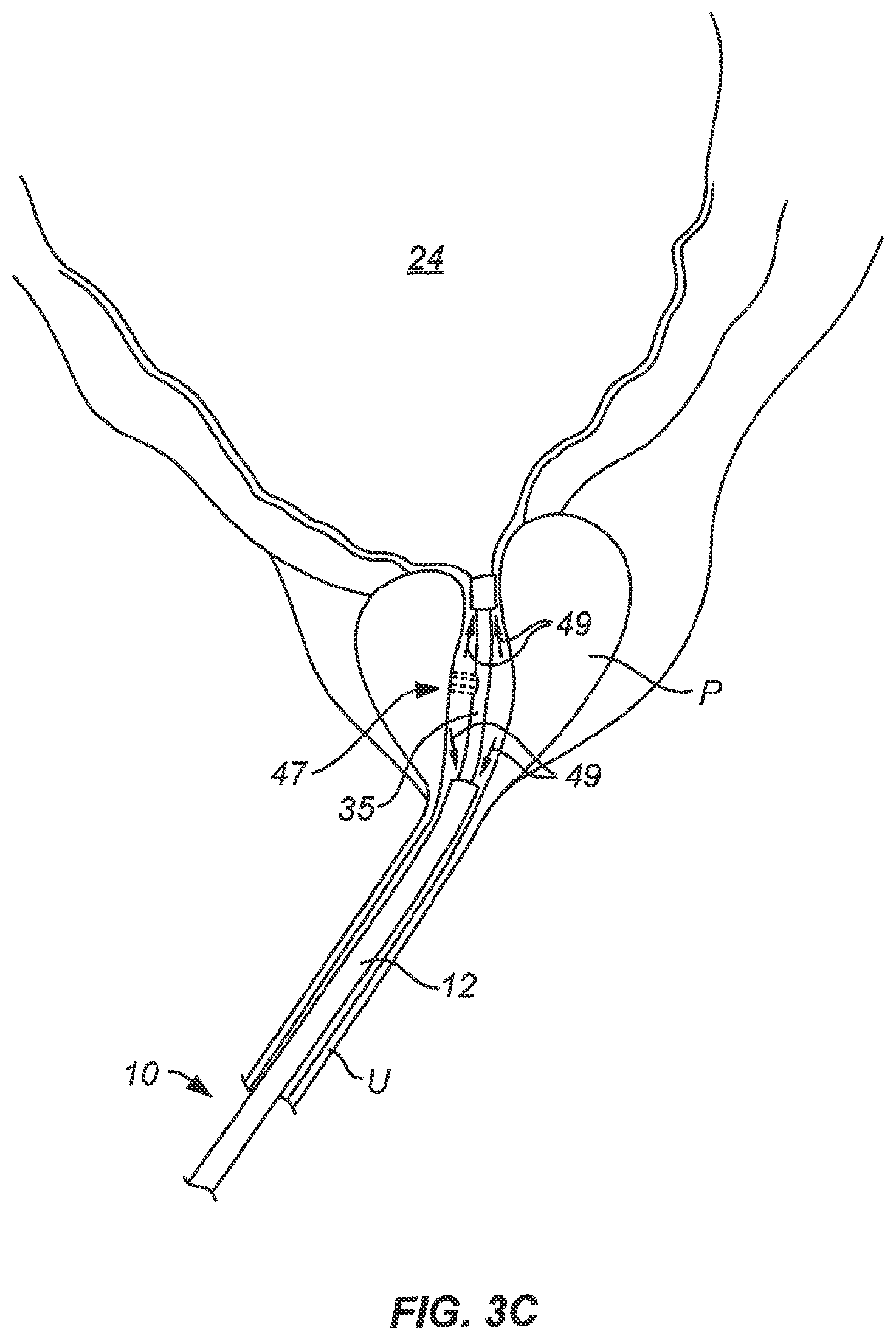 Patent US12318137 Figure 5 – Controlled tissue treatment with energy and control circuitry