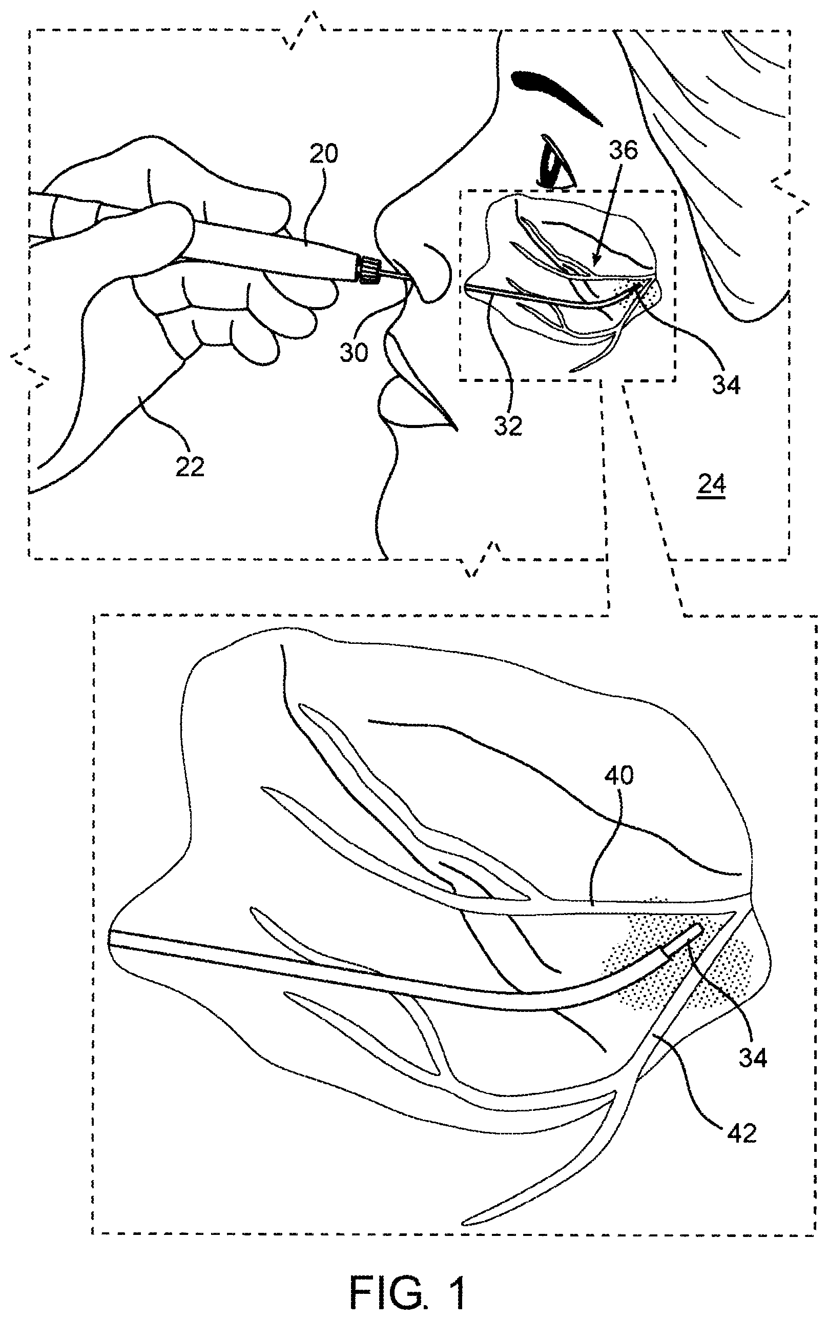 Patent US12318138 — Device and methods of laser treatment for rhinology — Figure 1
