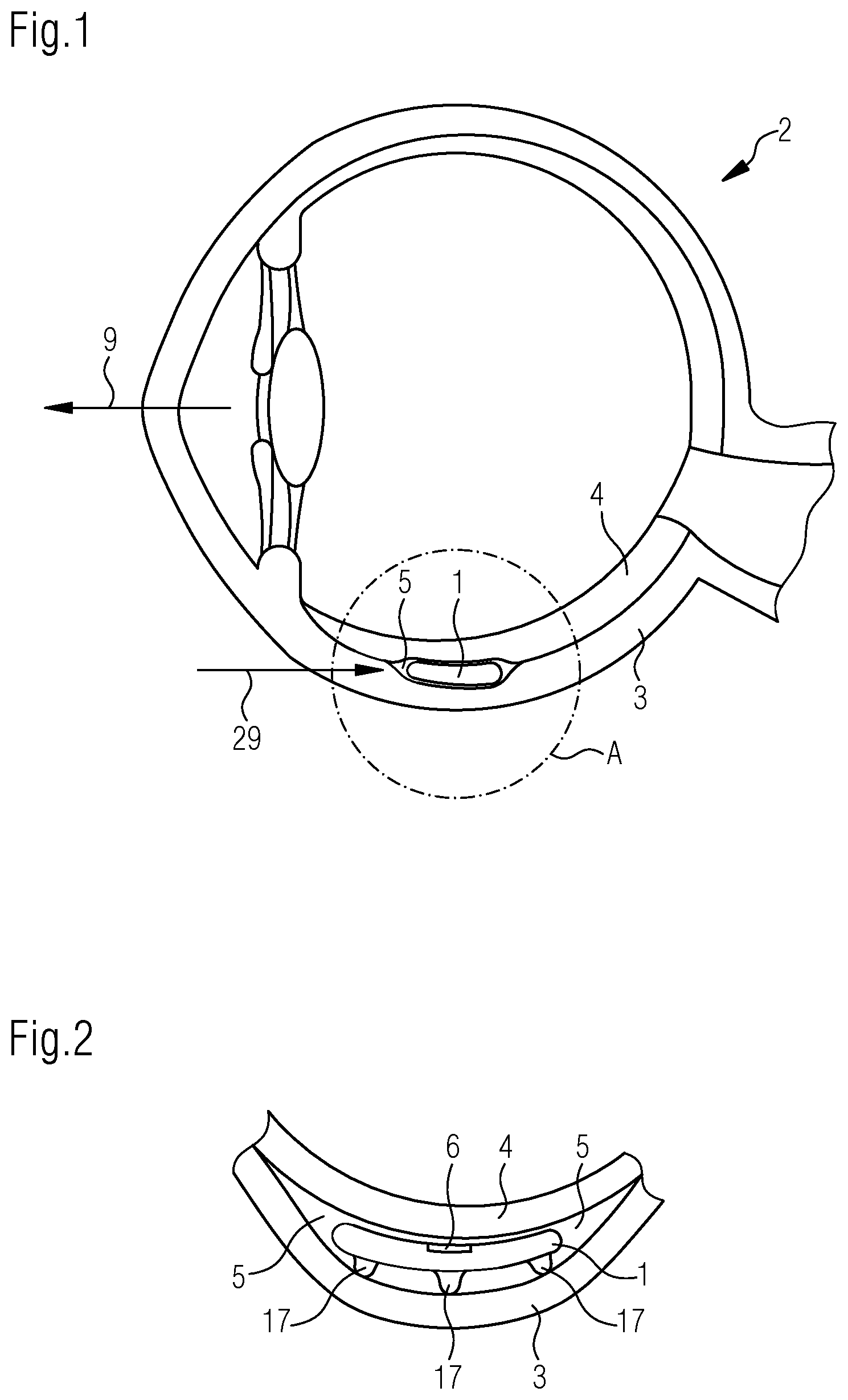 Patent US12318143 — Implant for determining intraocular pressure — Figure 1