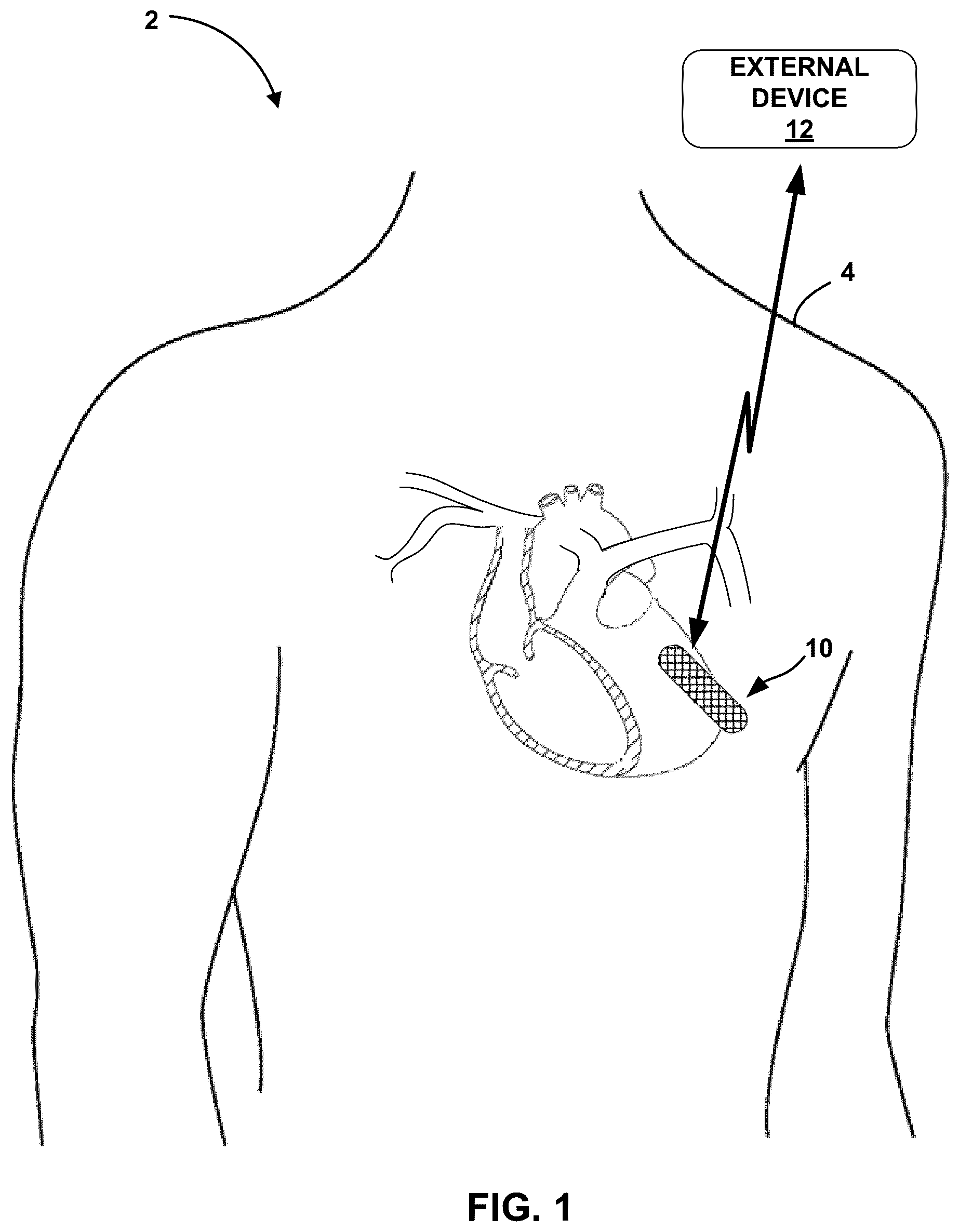 Patent US12318210 — Premature ventricular contraction (PVC) detection — Figure 1