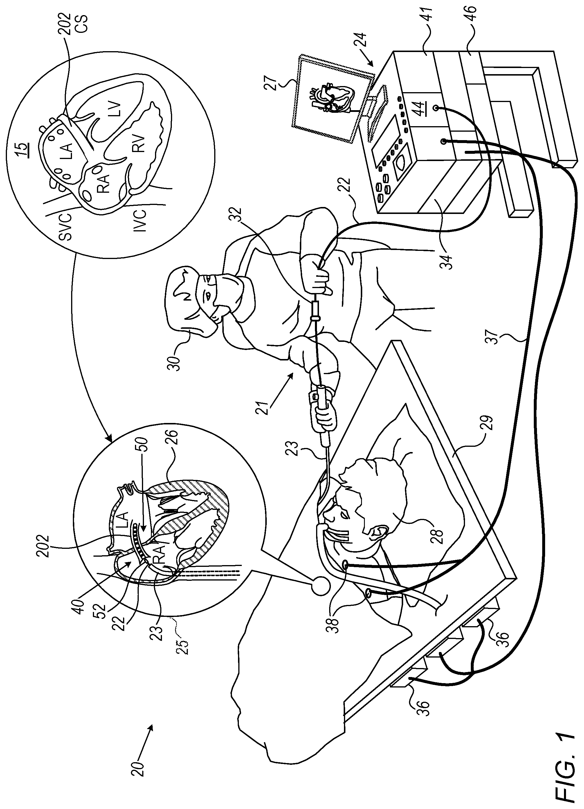 Patent US12318211 — Location-based pattern matching of coronary sinus (CS) signals — Figure 1