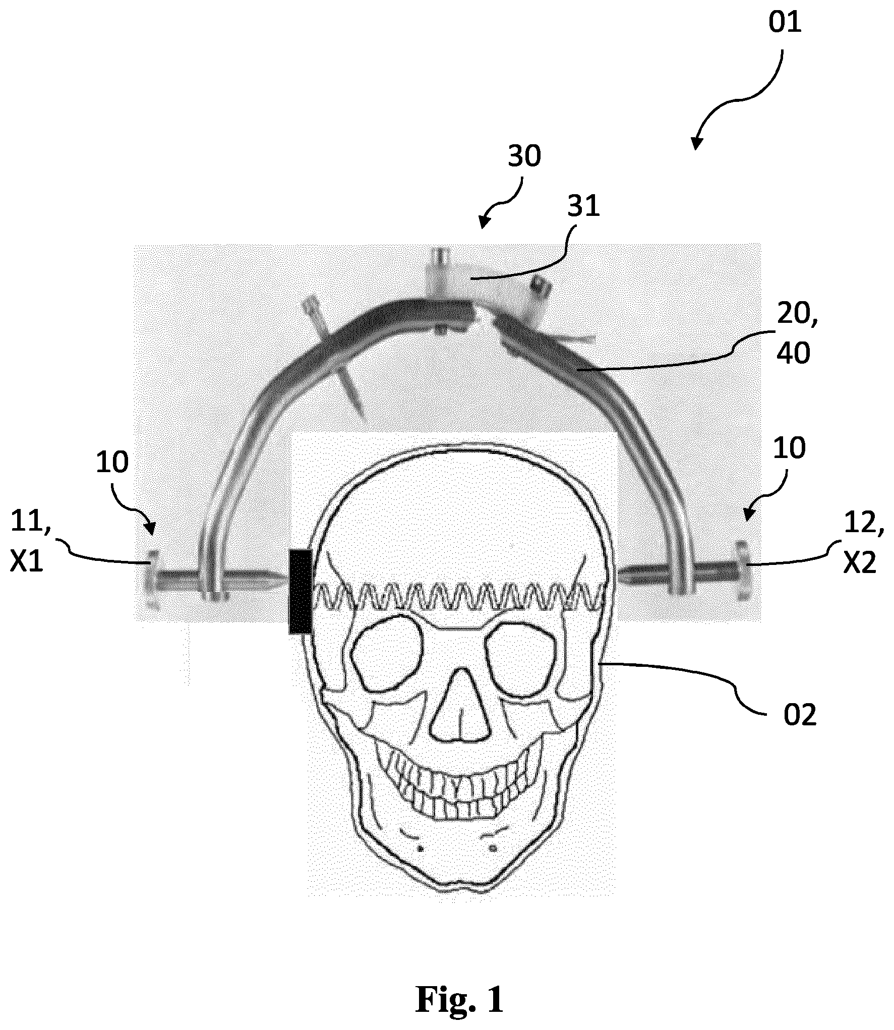 Patent US12318242 — Method and device for a non-invasive determination and/or monitoring of intracranial compliance — Figure 1