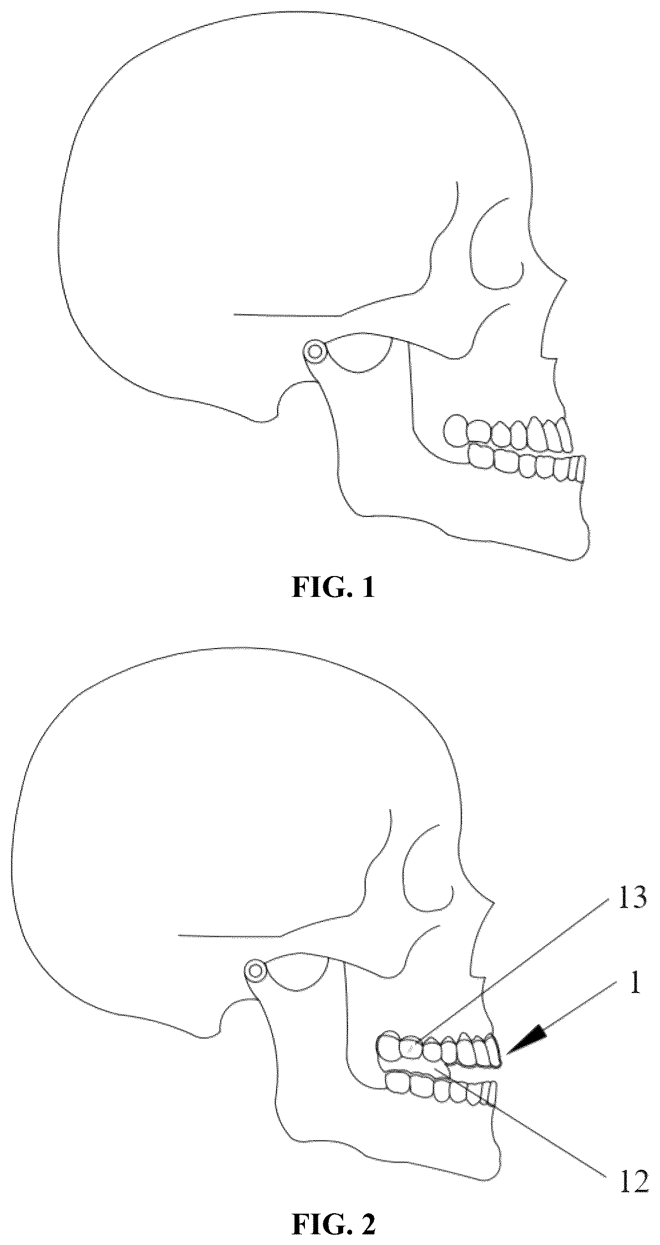 Patent US12318263 — Mandibular positioning facial retrognathism orthodontic system and design method thereof — Figure 1