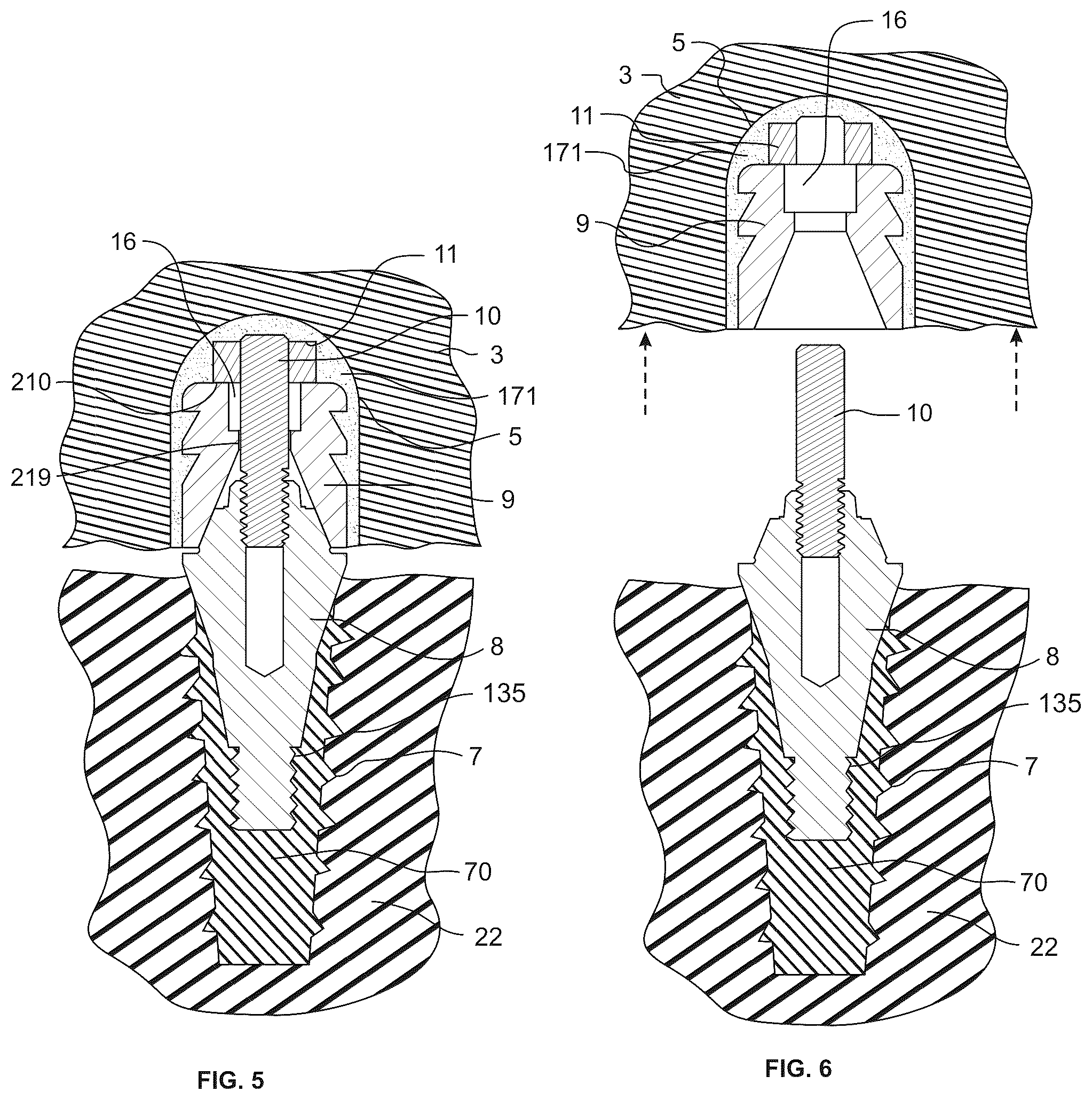 Patent US12318266 Figure 3 – Screw-attached pick-up dental coping systems and methods