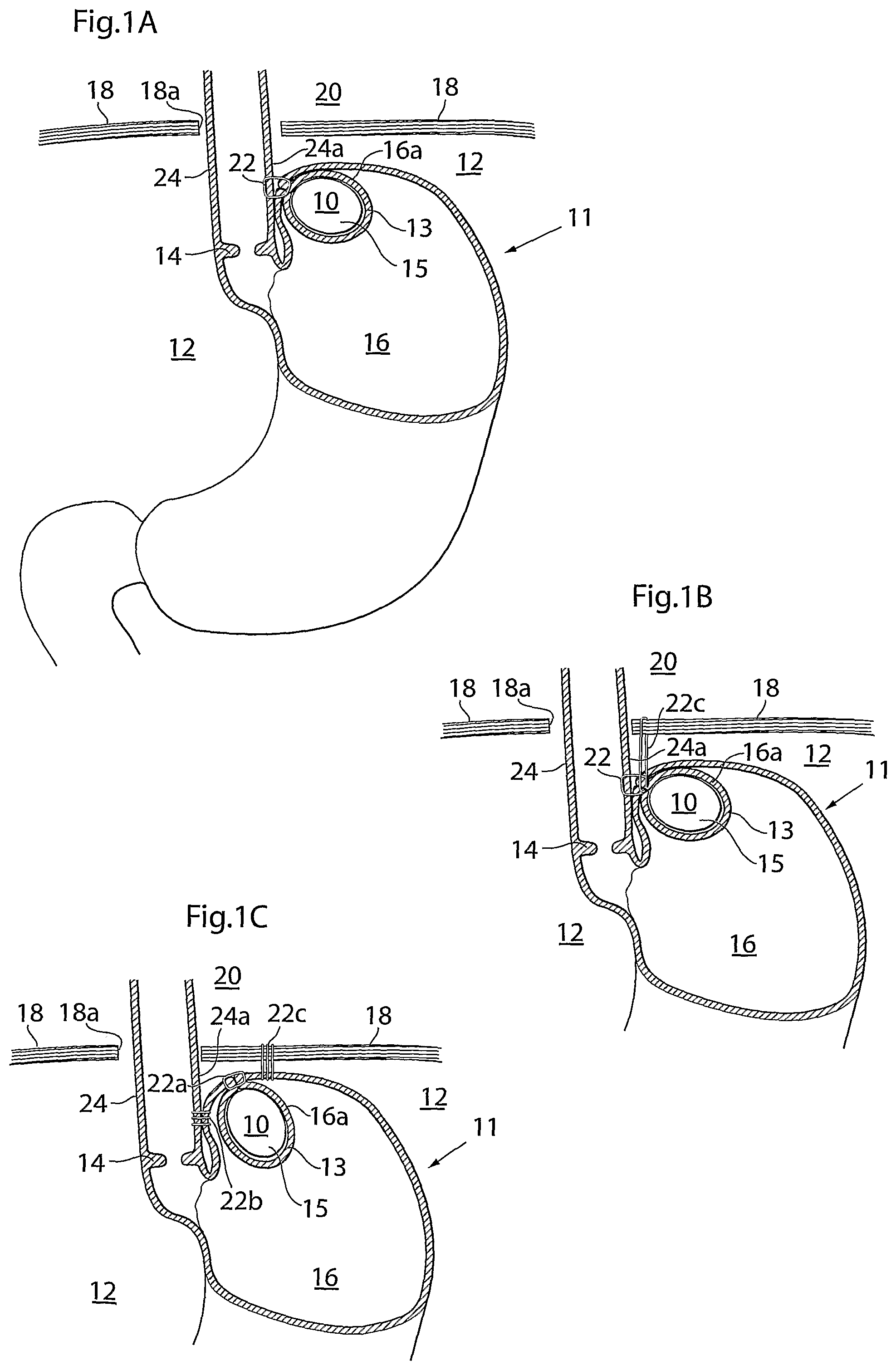 Patent US12318278 — Methods and instruments for treating GERD and hiatal hernia — Figure 1