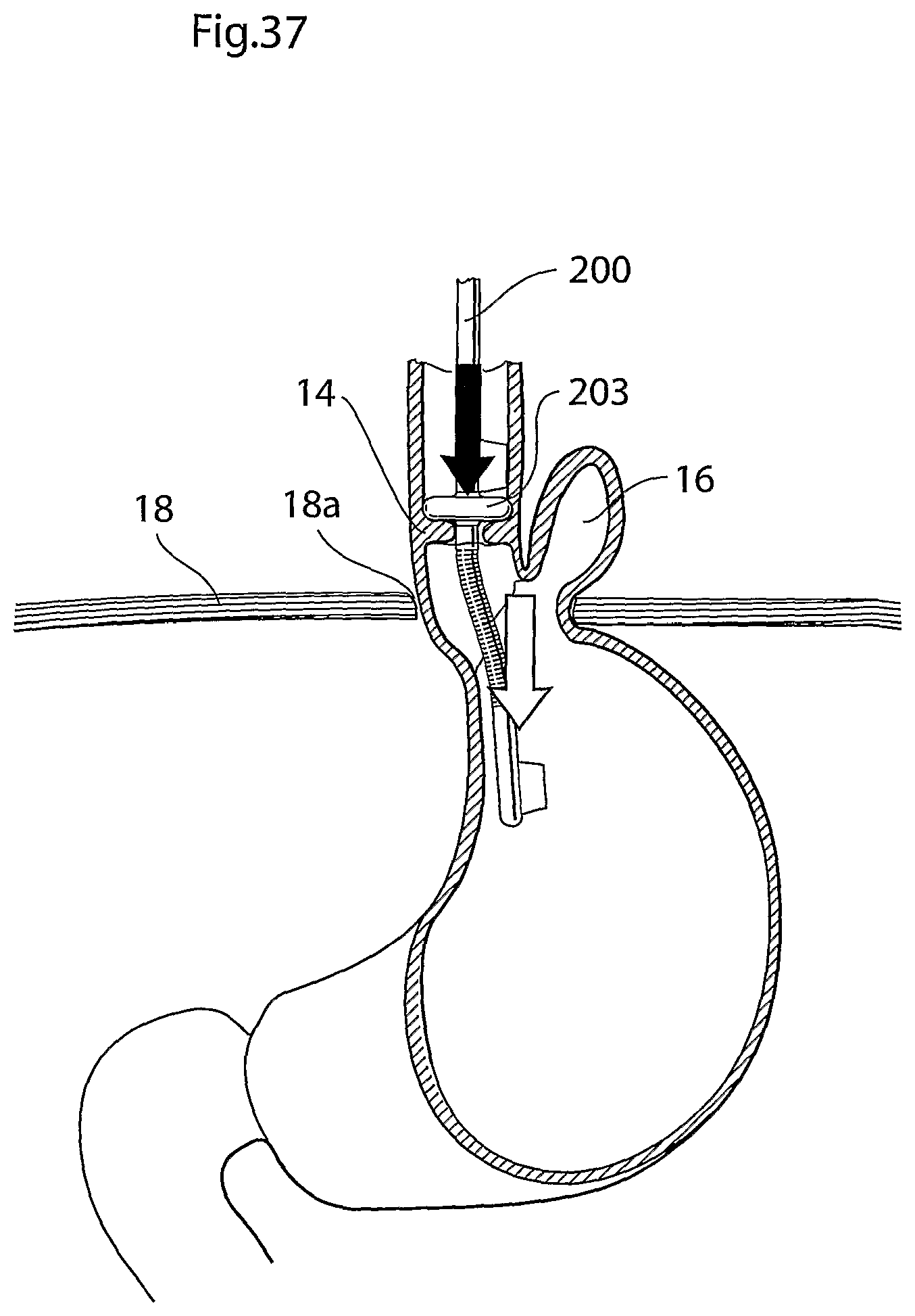 Patent US12318278 Figure 19 – Methods and instruments for treating GERD and hiatal hernia