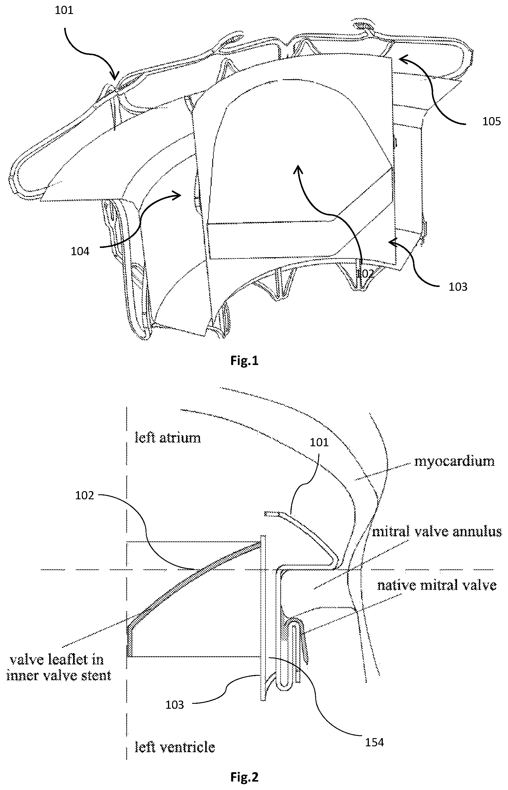 Patent US12318282 — Transapical implantable mitral valve device — Figure 1
