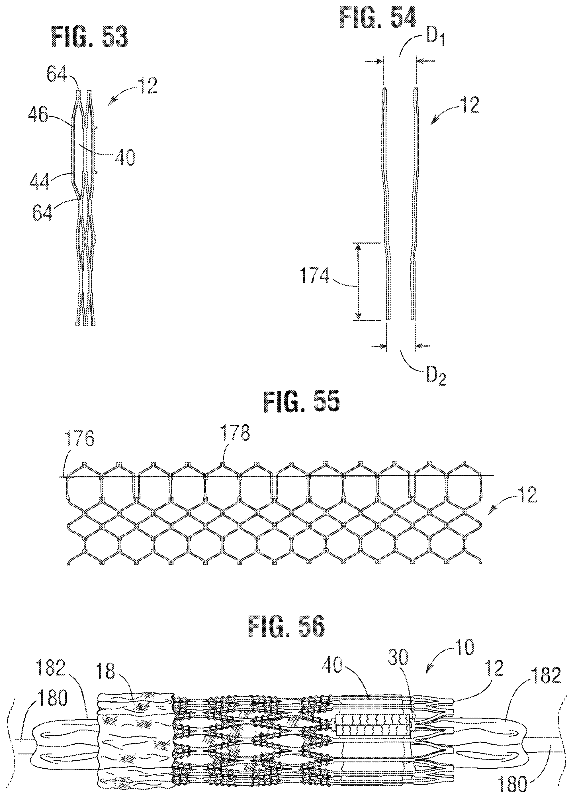 Patent US12318283 Figure 18 – Prosthetic heart valve
