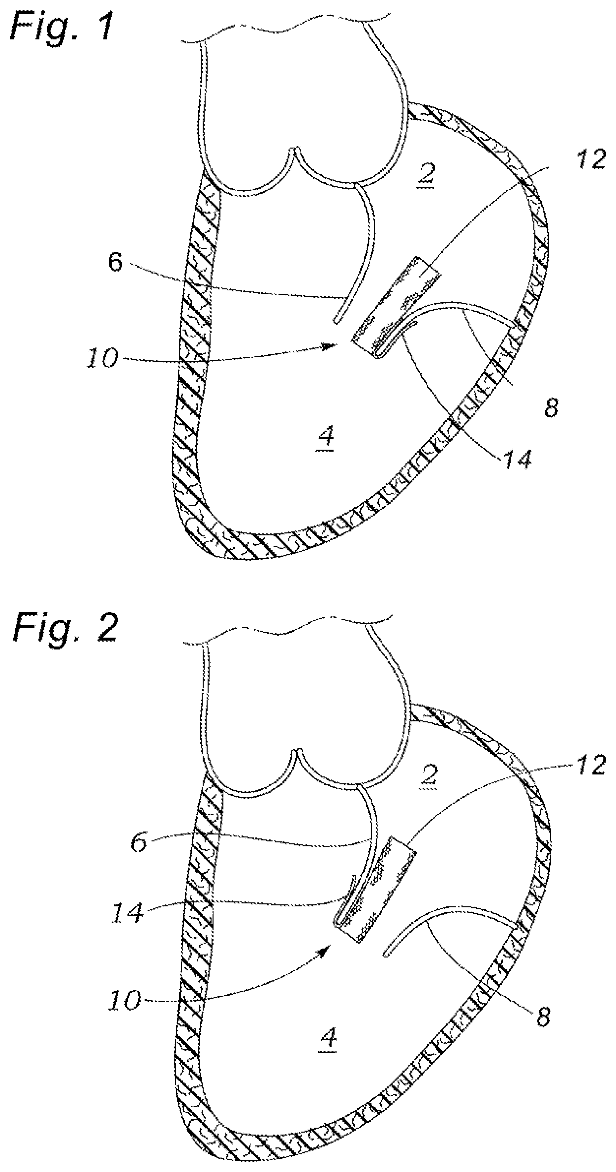 Patent US12318294 — Tissue grasping devices and related methods — Figure 1