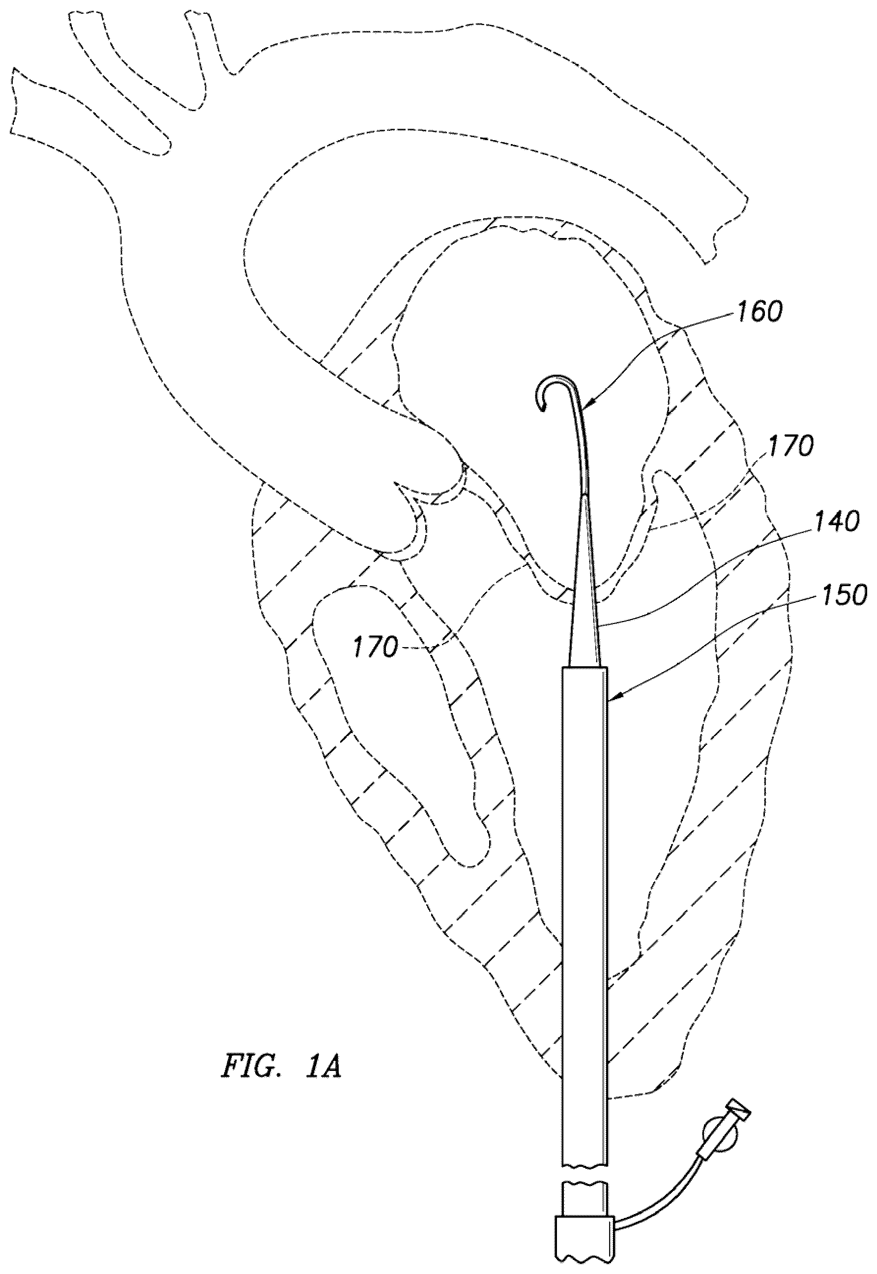 Patent US12318295 — Cardiac prosthesis — Figure 1