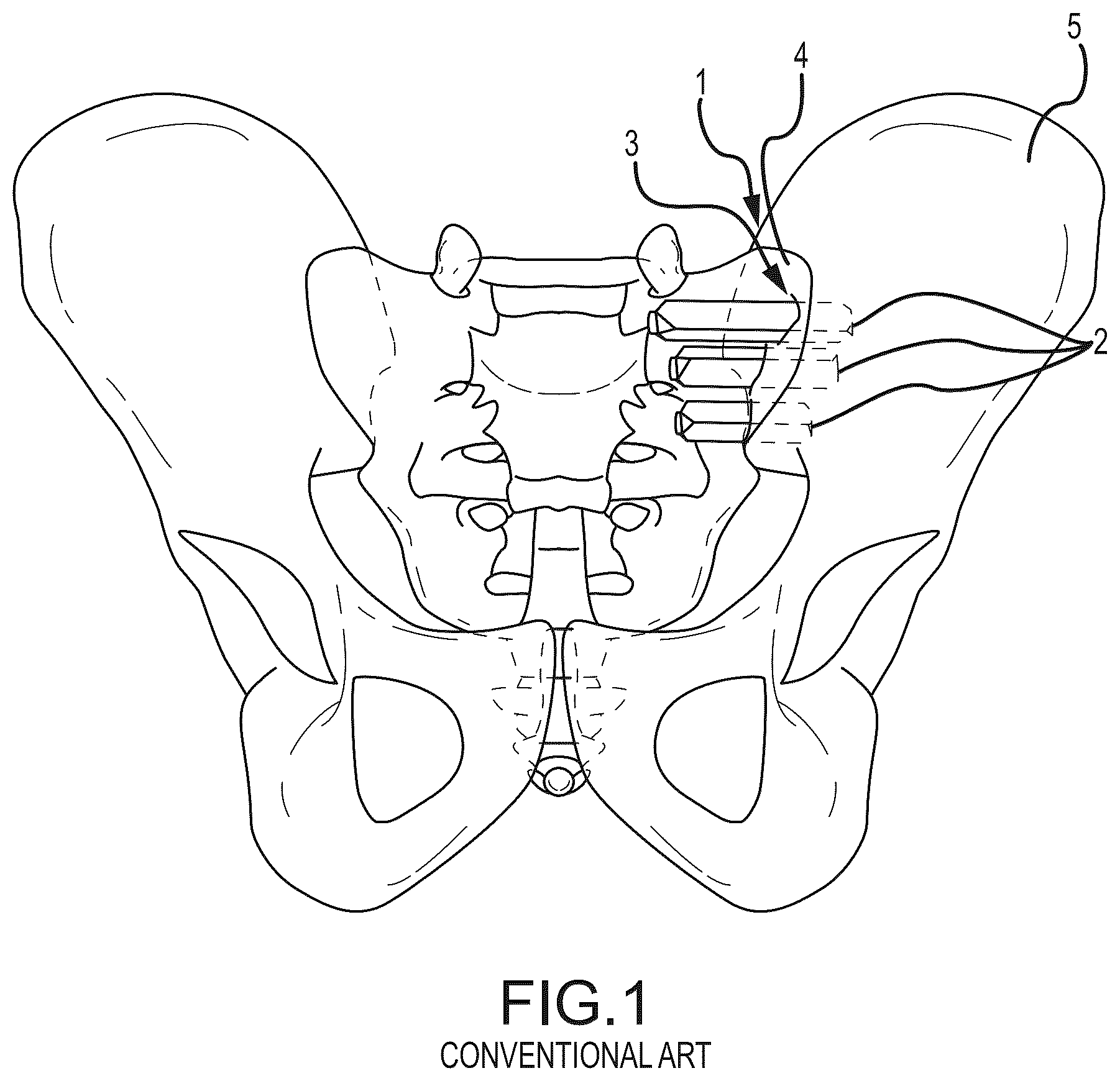 Patent US12318298 — Sacropelvic fusion implant system for providing a foundation for spinopelvic fixation constructs in adult spinal deformity surgery — Figure 1