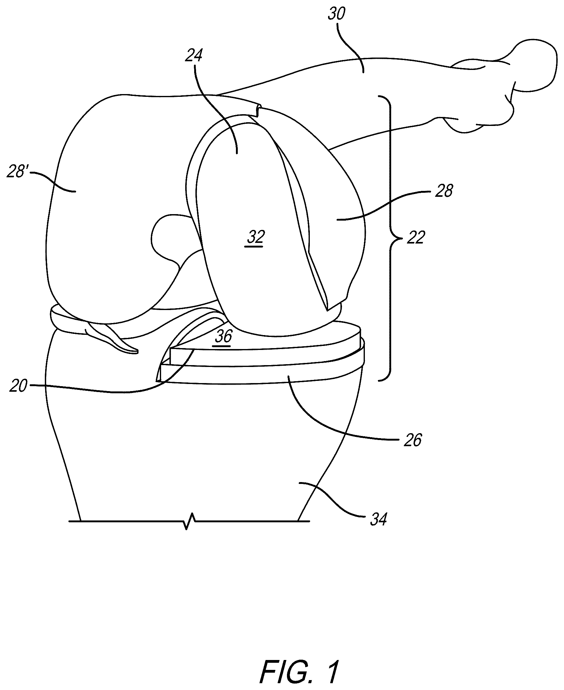 Patent US12318300 — Tibial insert with variable articular surface — Figure 1