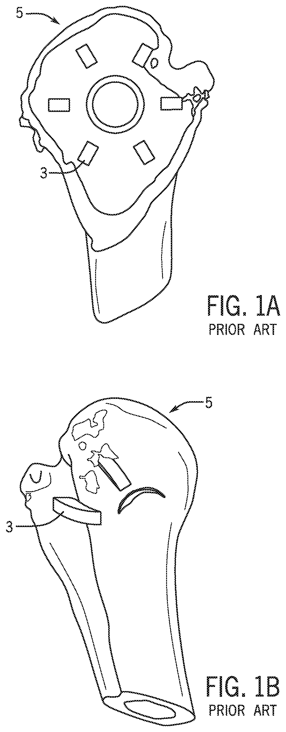 Patent US12318301 — Method for modeling humeral anatomy and optimization of component design — Figure 1