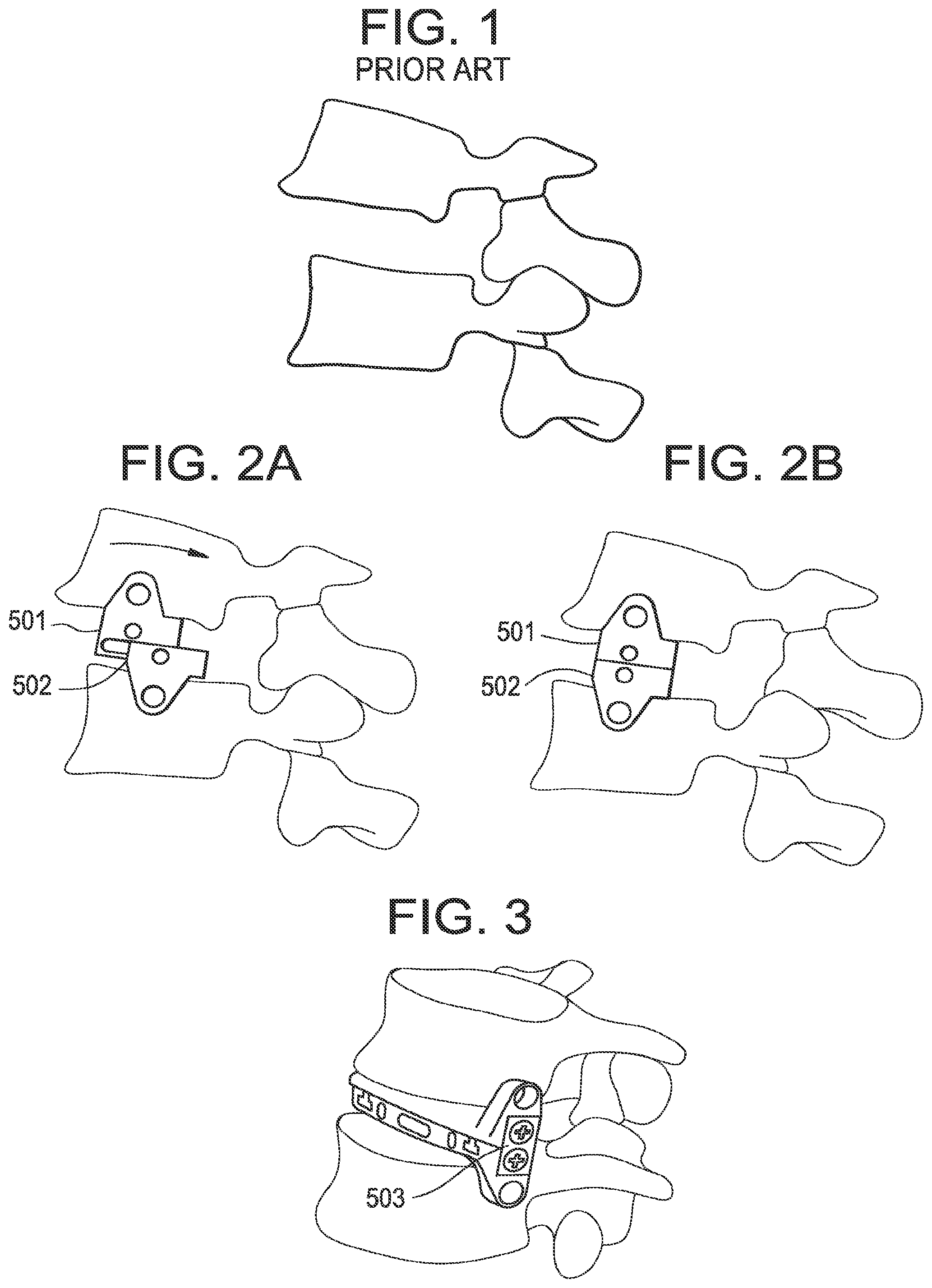 Patent US12318304 — Lateral spondylolisthesis reduction cage — Figure 1
