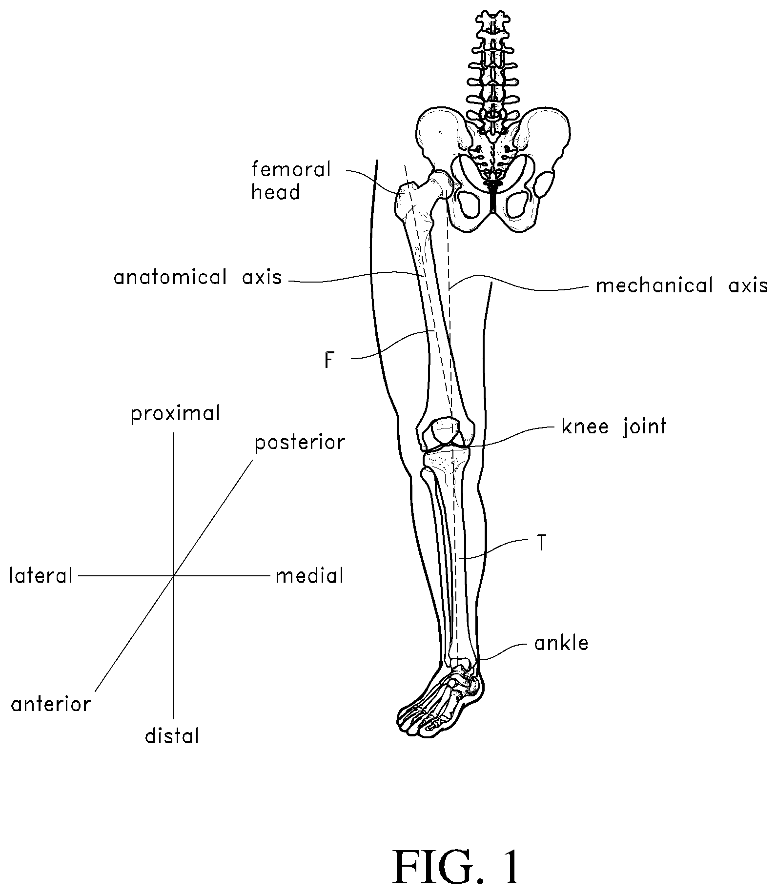 Patent US12318313 — Systems and methods for joint replacement — Figure 1