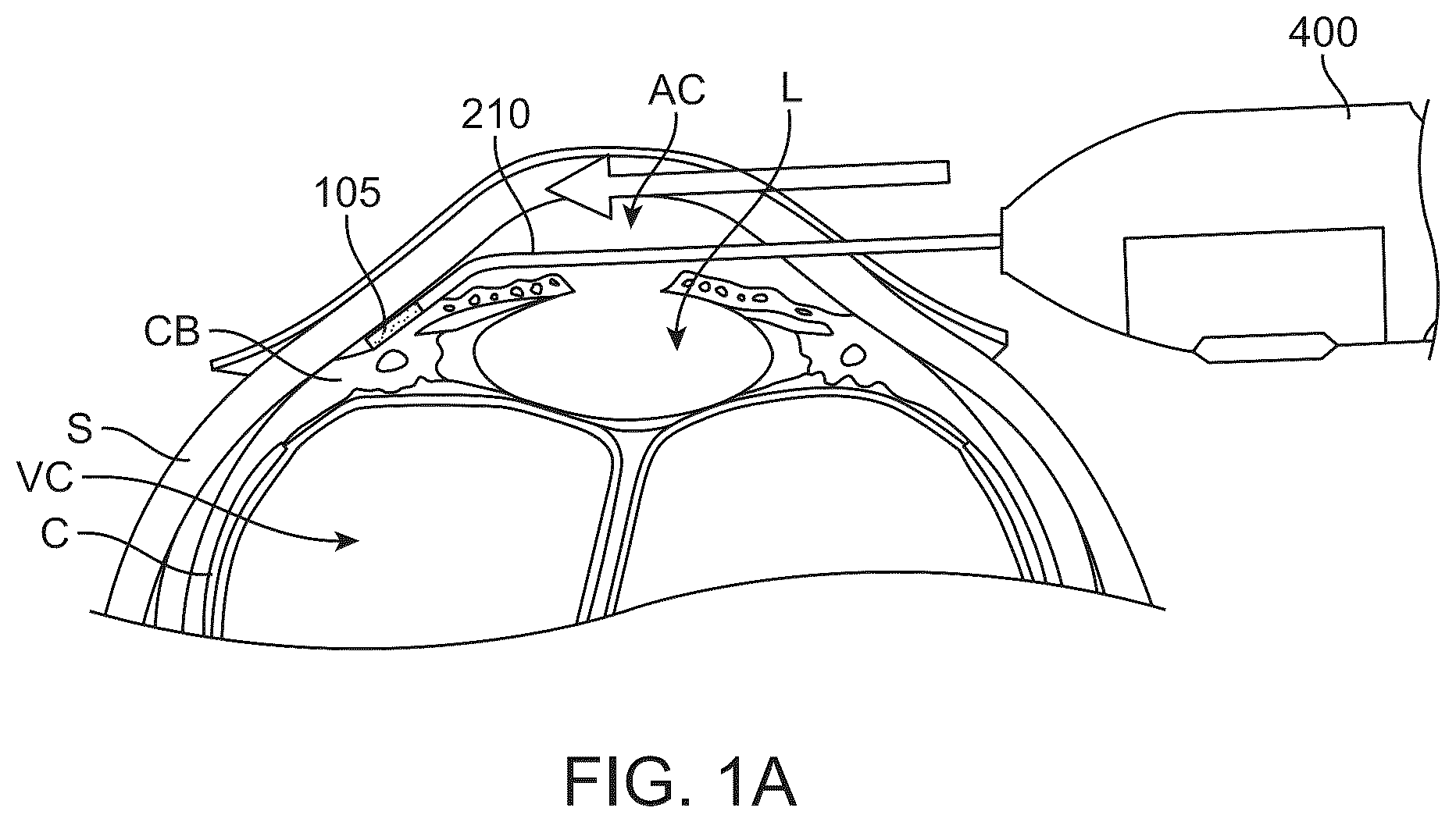 Patent US12318328 — System for shaping and implanting biologic intraocular stent for increased aqueous outflow and lowering of intraocular pressure — Figure 1