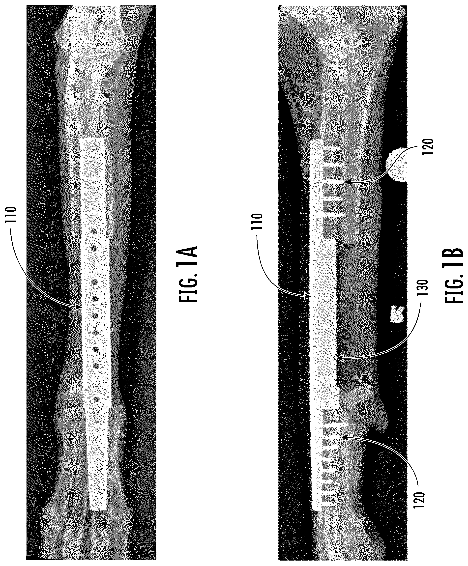 Patent US12318510 Figure 1 – Methods and devices for improving bone healing