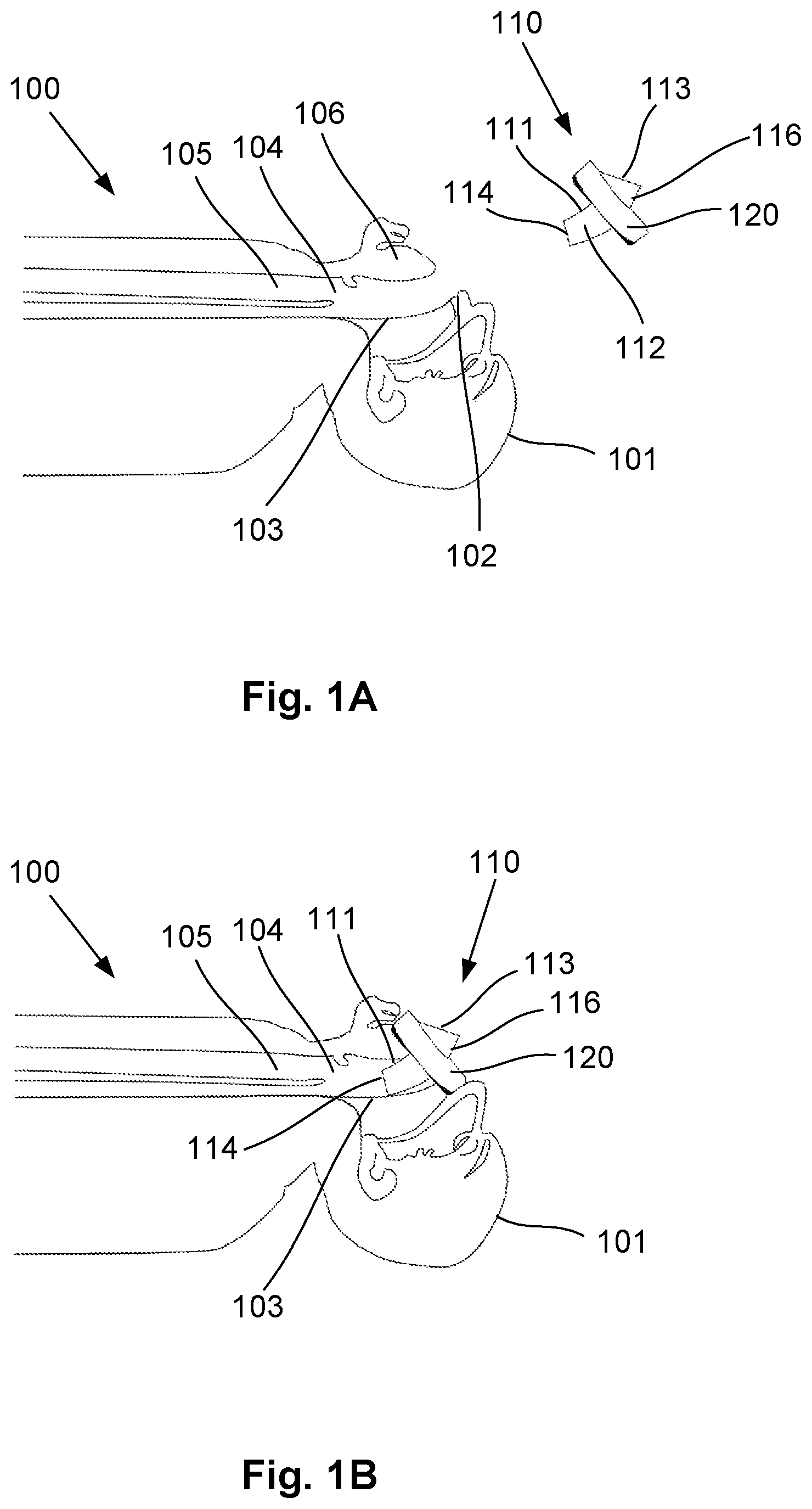 Patent US12318541 — Shielded intubation guide and method — Figure 1
