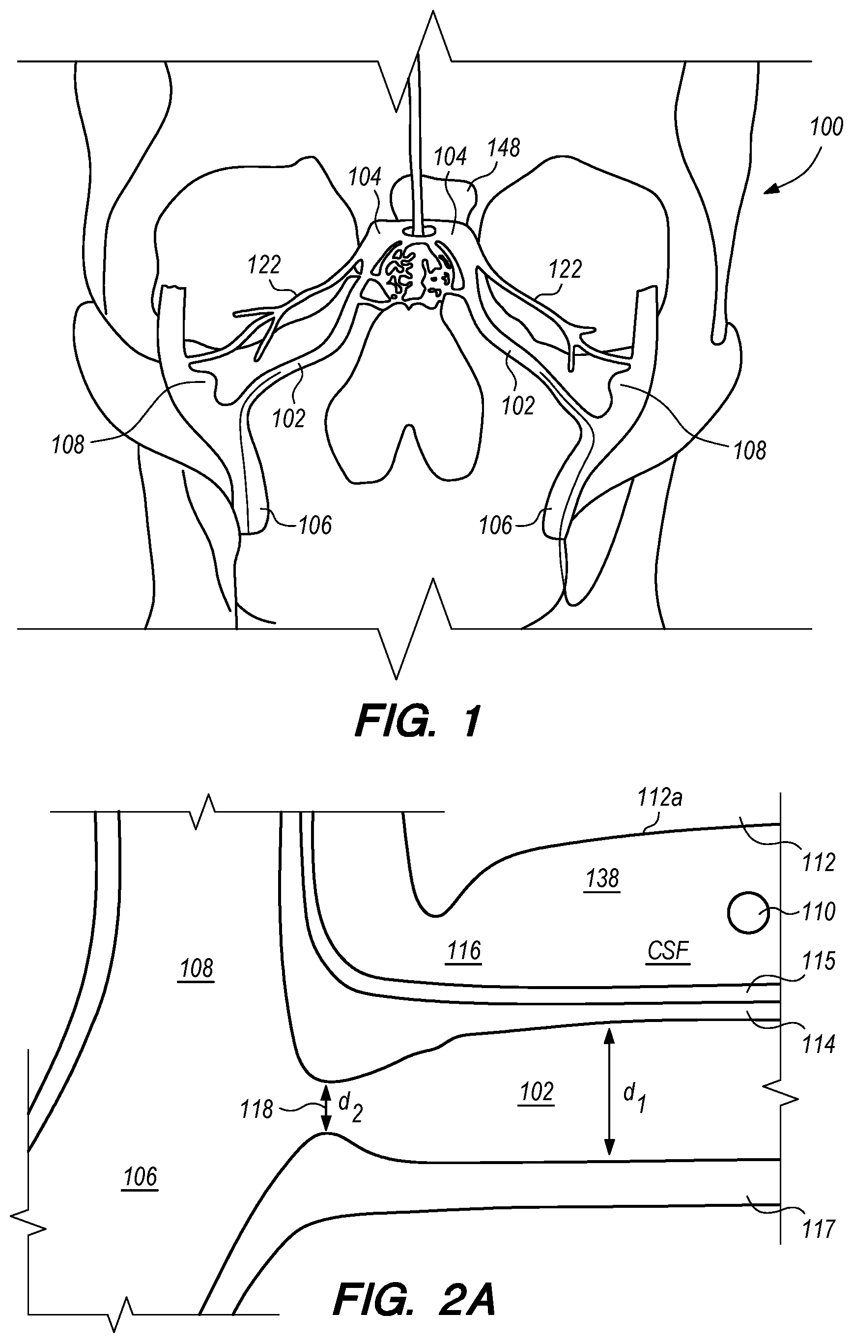 Patent US12318564 Figure 1 – Catheter systems and methods for medical procedures using catheters