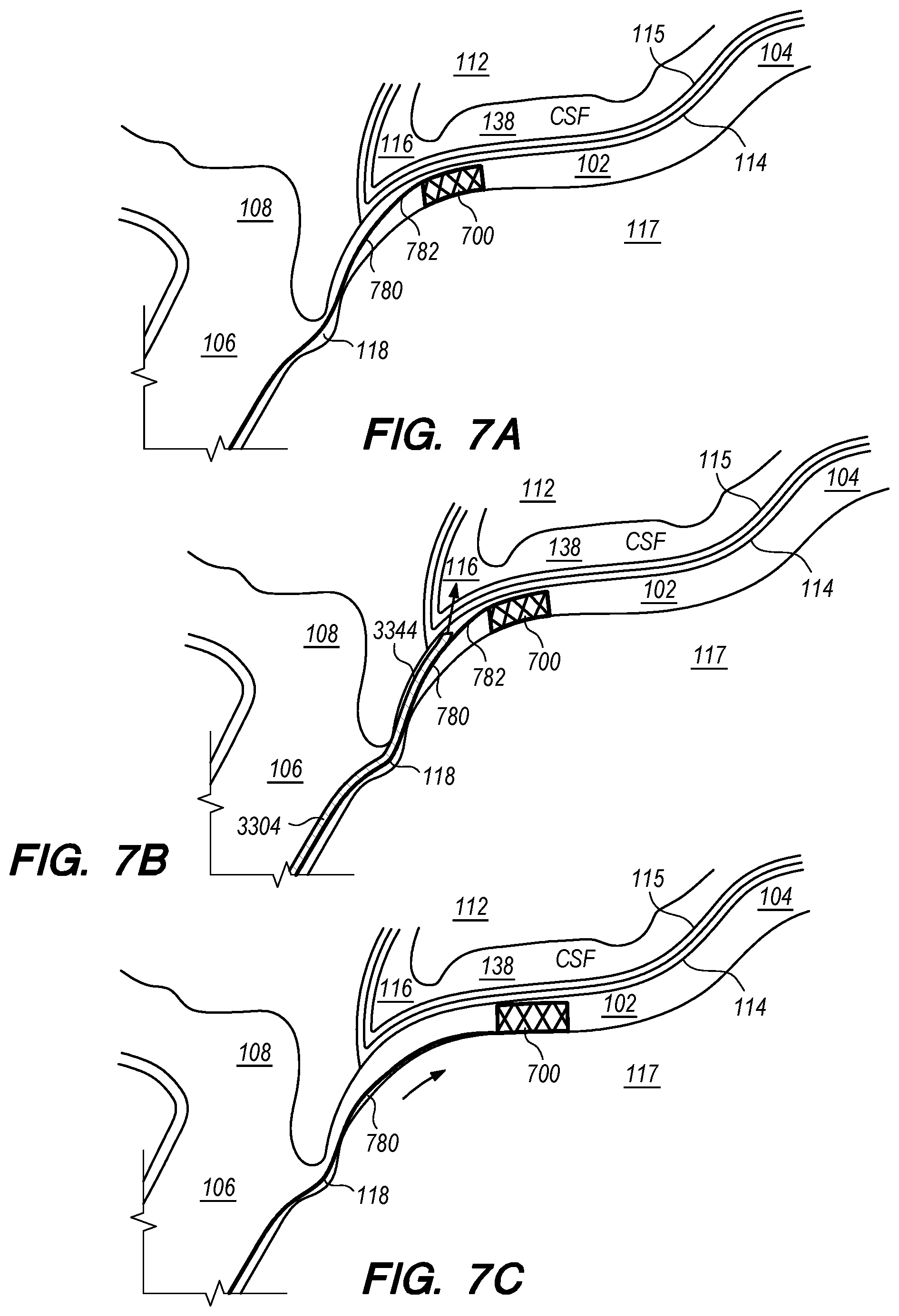 Patent US12318564 Figure 14 – Catheter systems and methods for medical procedures using catheters