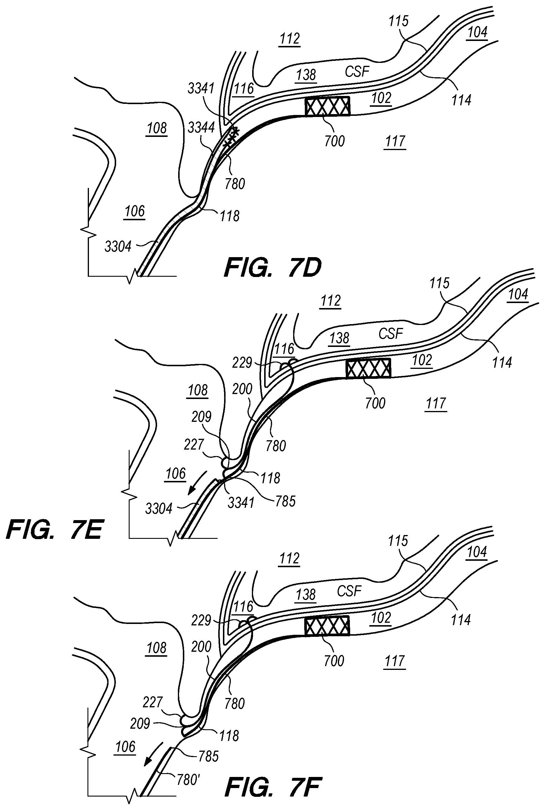Patent US12318564 Figure 15 – Catheter systems and methods for medical procedures using catheters