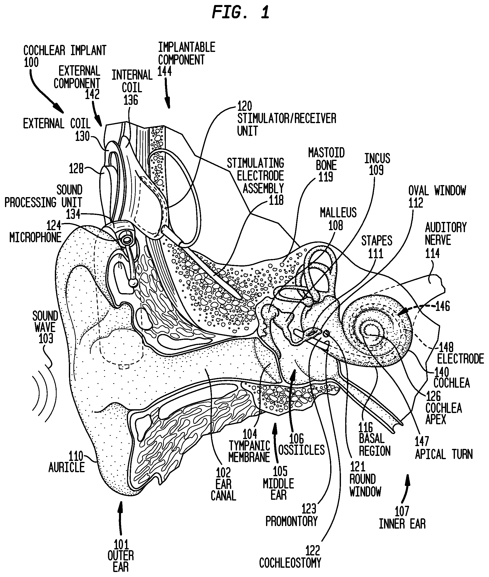 Patent US12318605 — Implantable device migration control — Figure 1