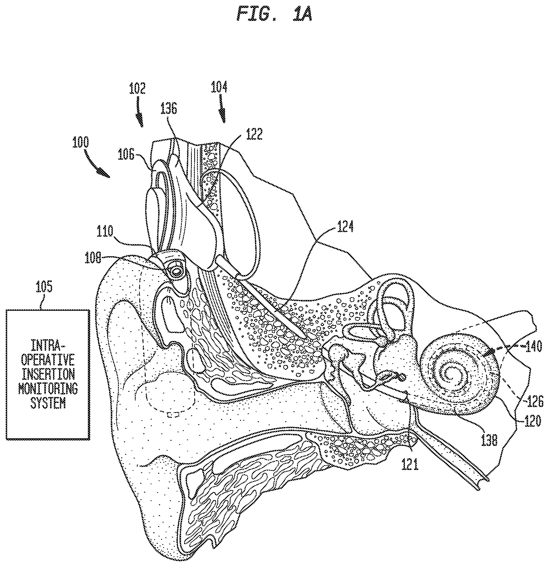 Patent US12318606 — Monitoring stimulating assembly insertion — Figure 1