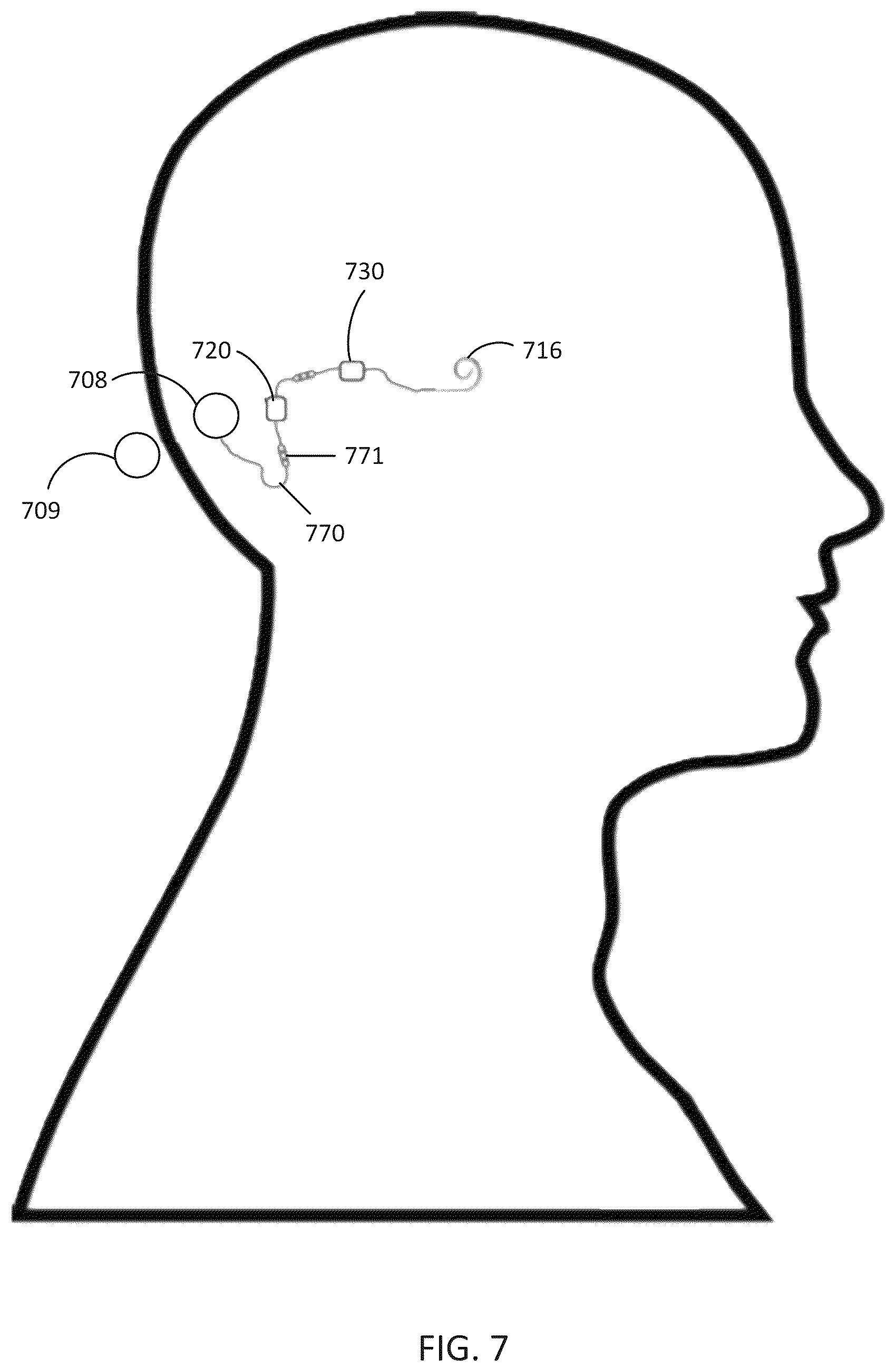 Patent US12318607 Figure 7 – Implantable cochlear system with integrated components and lead characterization