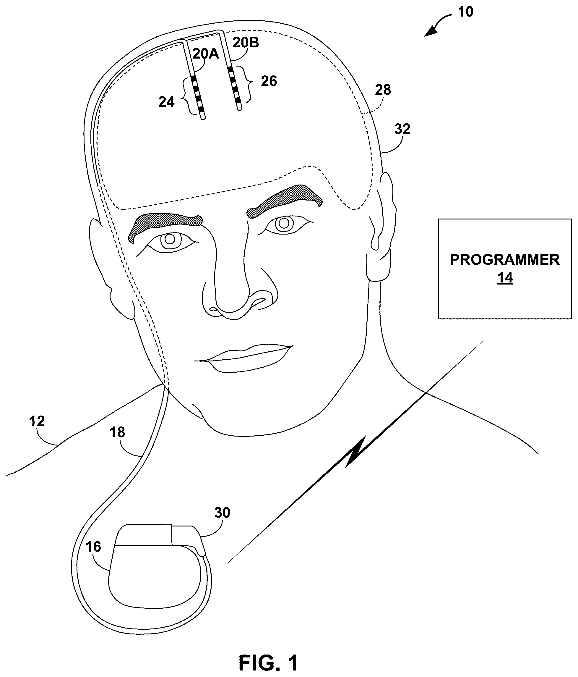 Patent US12318619 — Medical leads and techniques for manufacturing the same — Figure 1