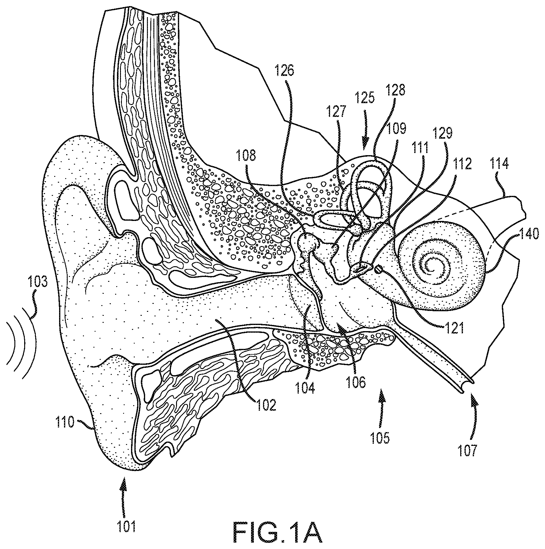 Patent US12323771 — Systems for accommodating separation of body parts in auditory prostheses — Figure 1