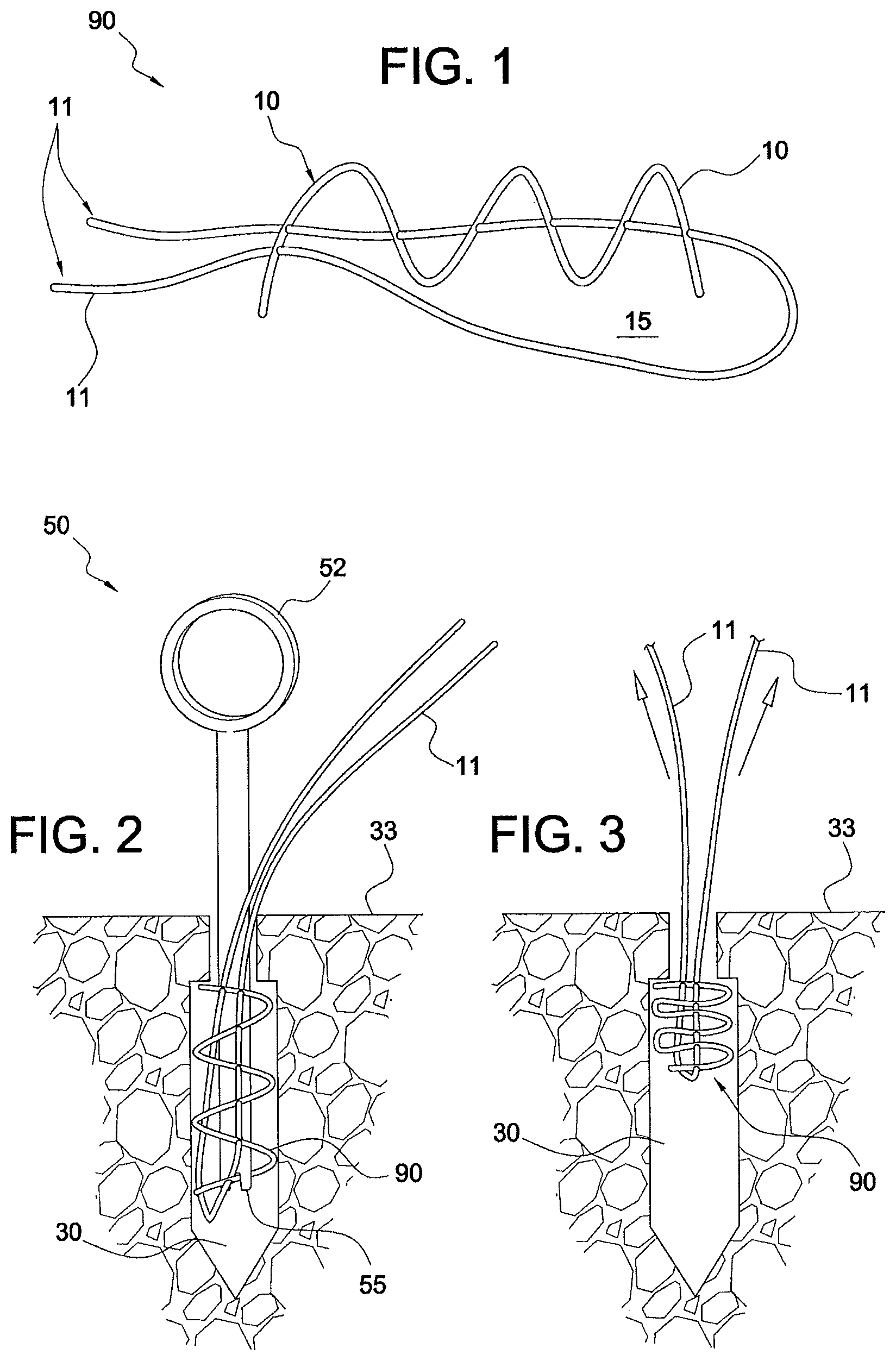 Patent US12324573 — Soft suture-based anchors — Figure 1