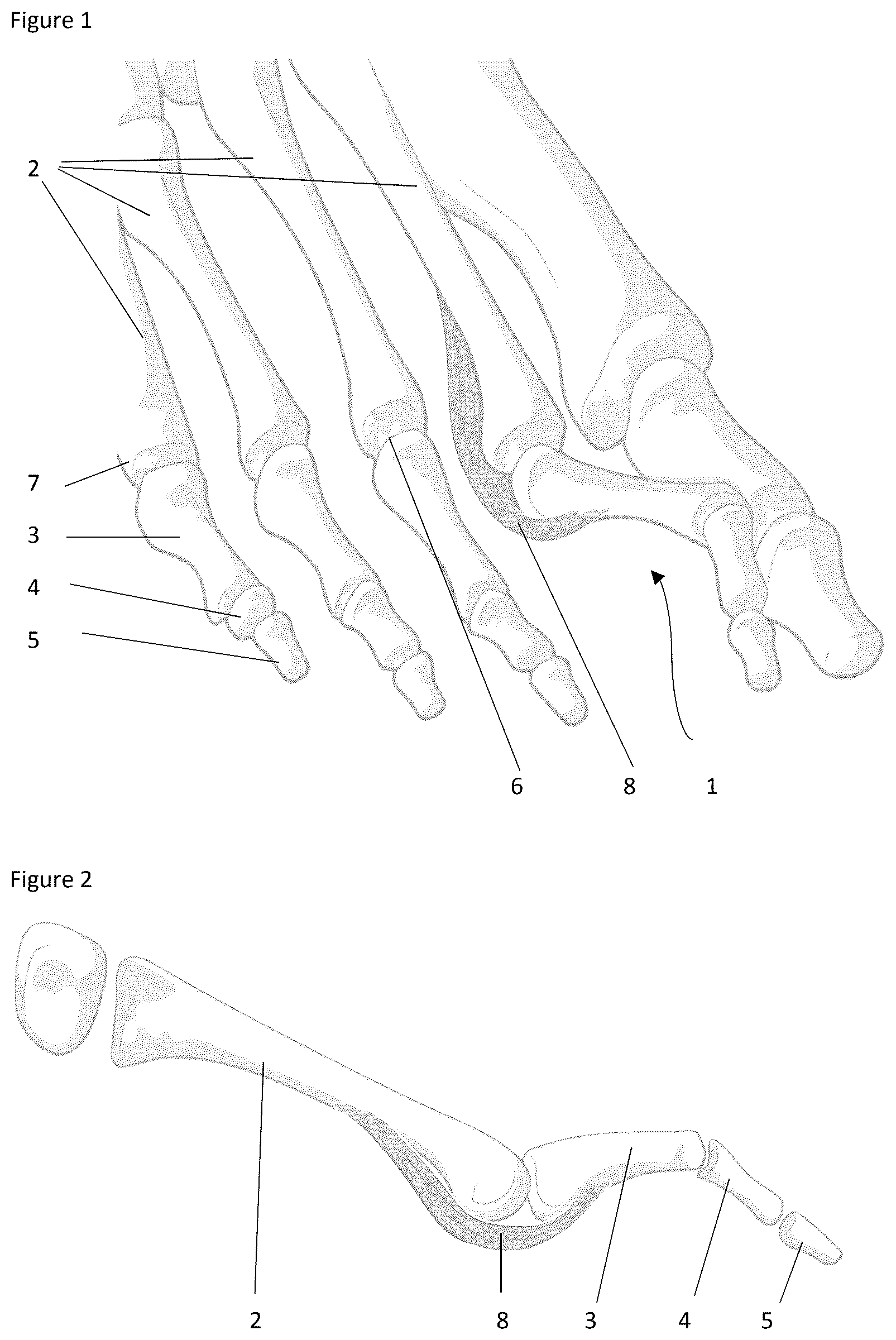 Patent US12324574 — Surgical methods for the treatment of plantar plate injury — Figure 1
