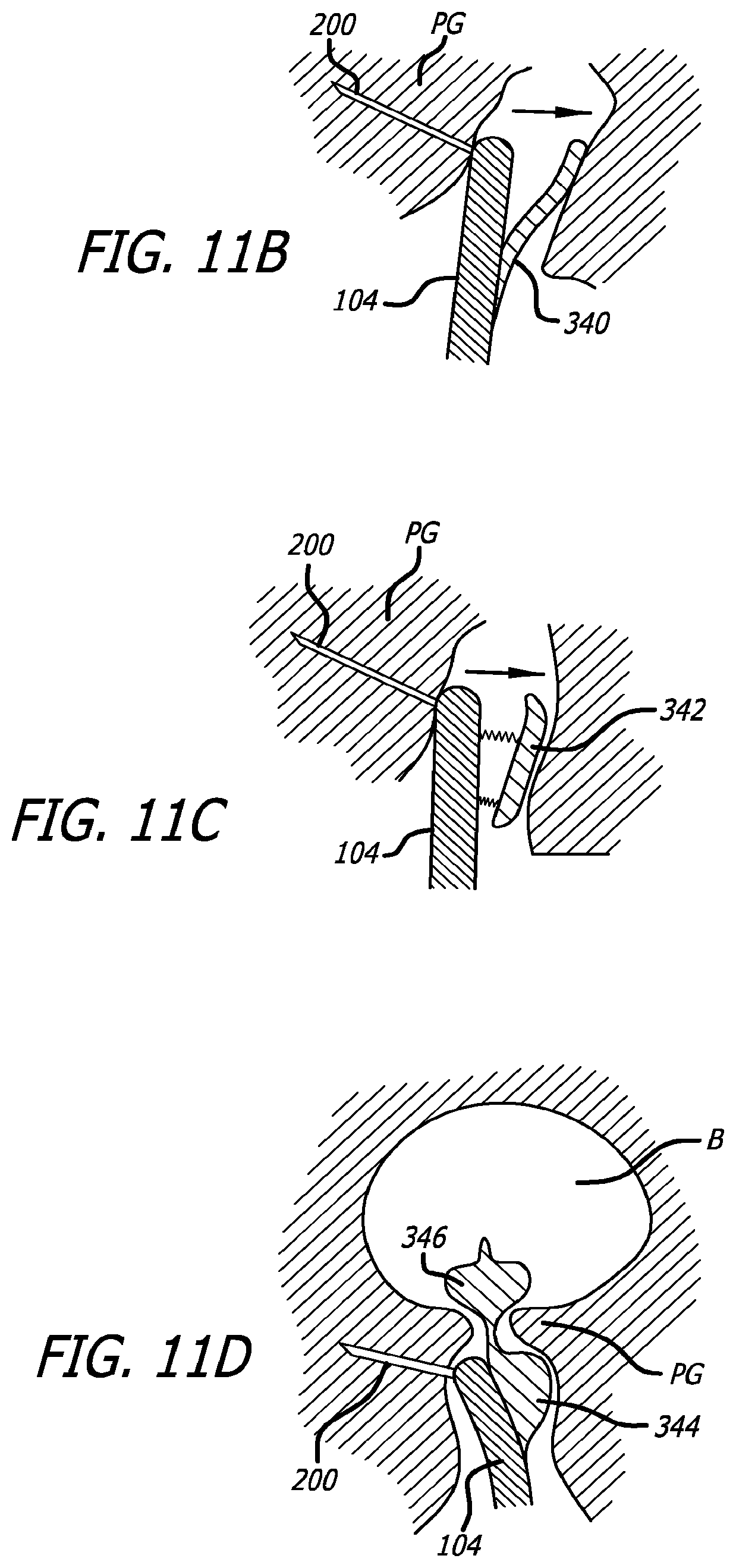 Patent US12324576 Figure 12 – Flexible system for delivering an anchor