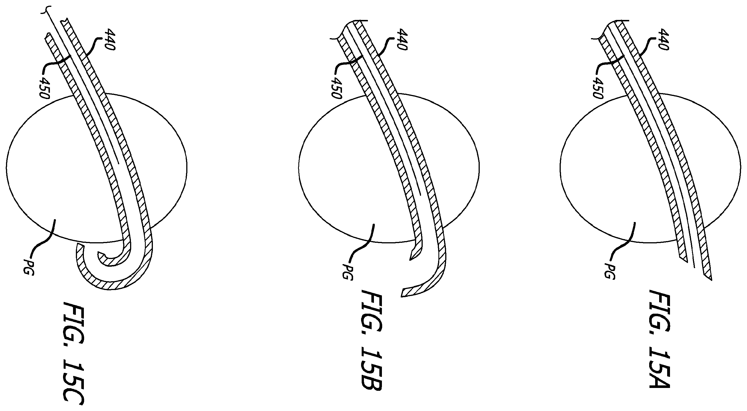 Patent US12324576 Figure 16 – Flexible system for delivering an anchor