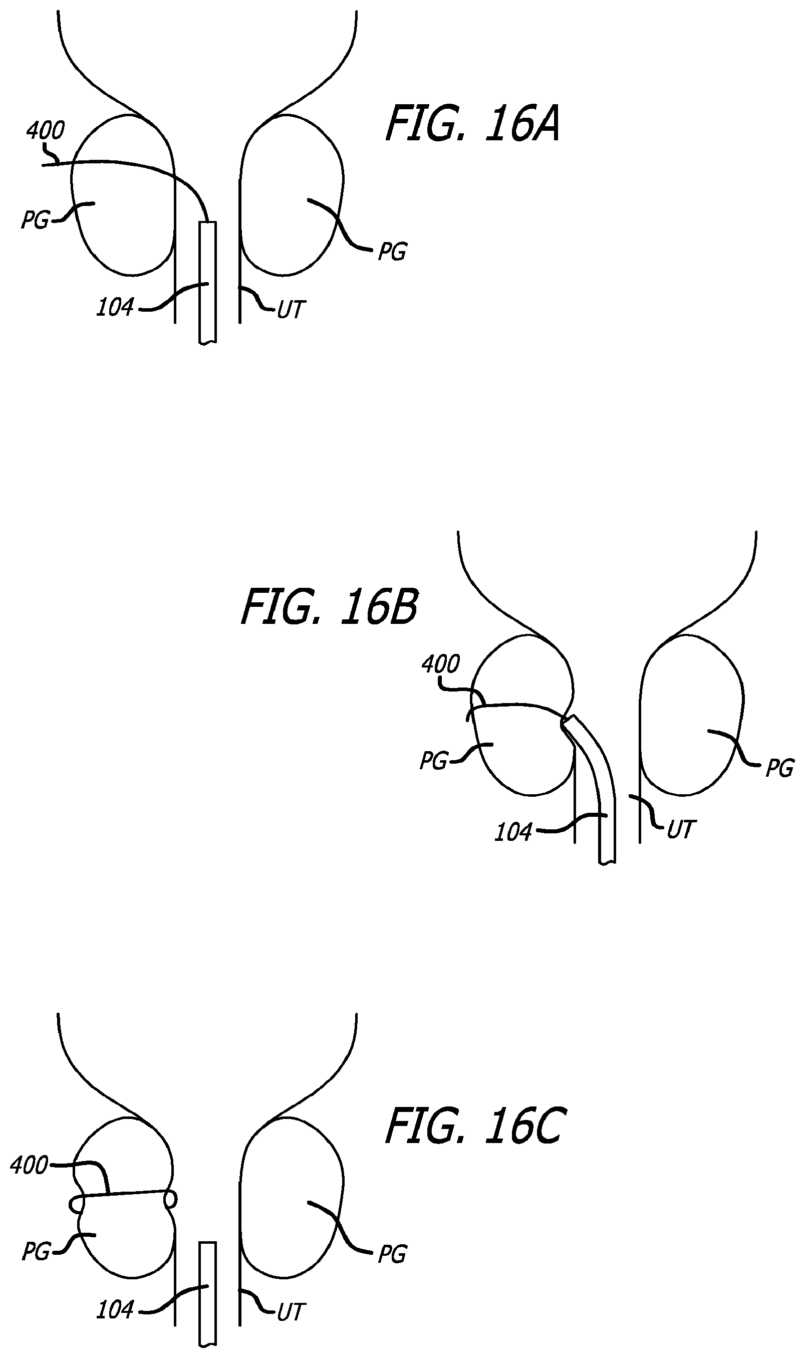 Patent US12324576 Figure 17 – Flexible system for delivering an anchor