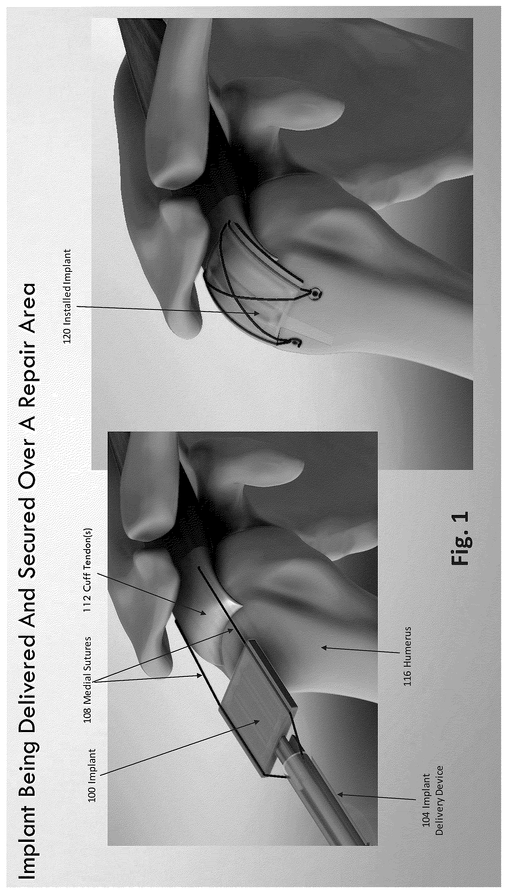Patent US12324577 — Method of augmenting tissue — Figure 1