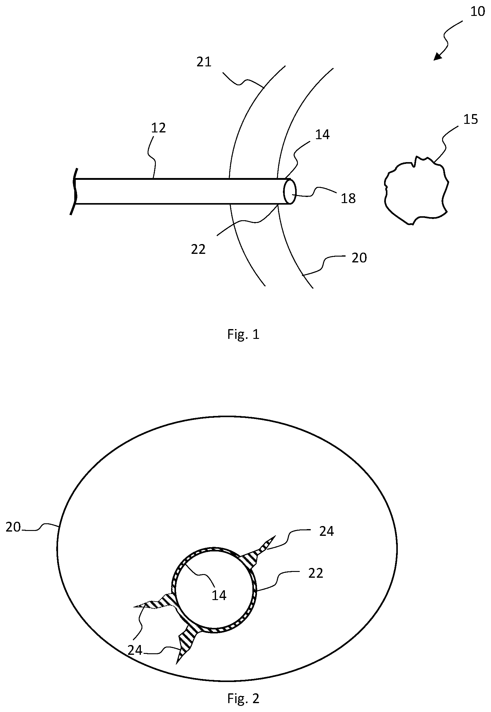 Patent US12324587 — Multistage bioabsorbable plug system — Figure 1