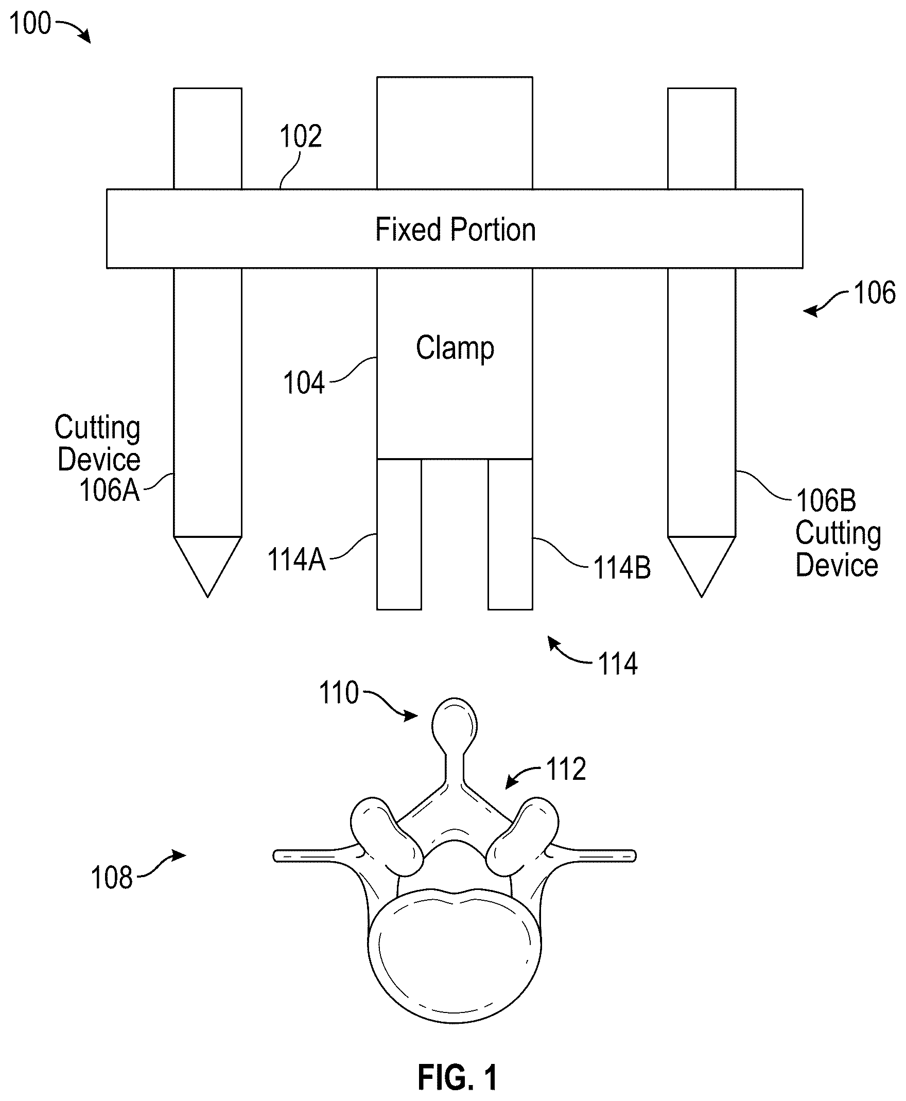 Patent US12324596 Figure 1 – Apparatus and bone cutting device for removal of bone tissue