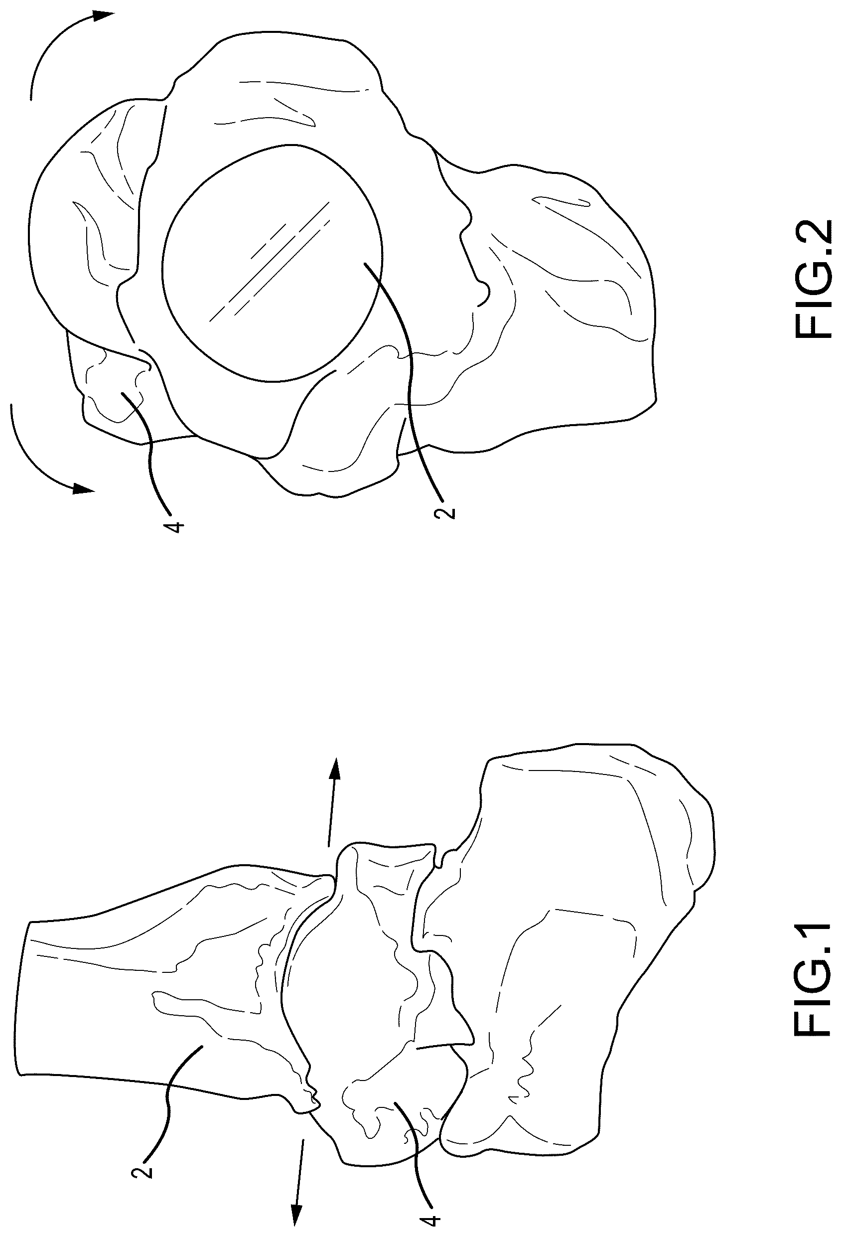 Patent US12324597 — Methods and systems for arthroplasty — Figure 1
