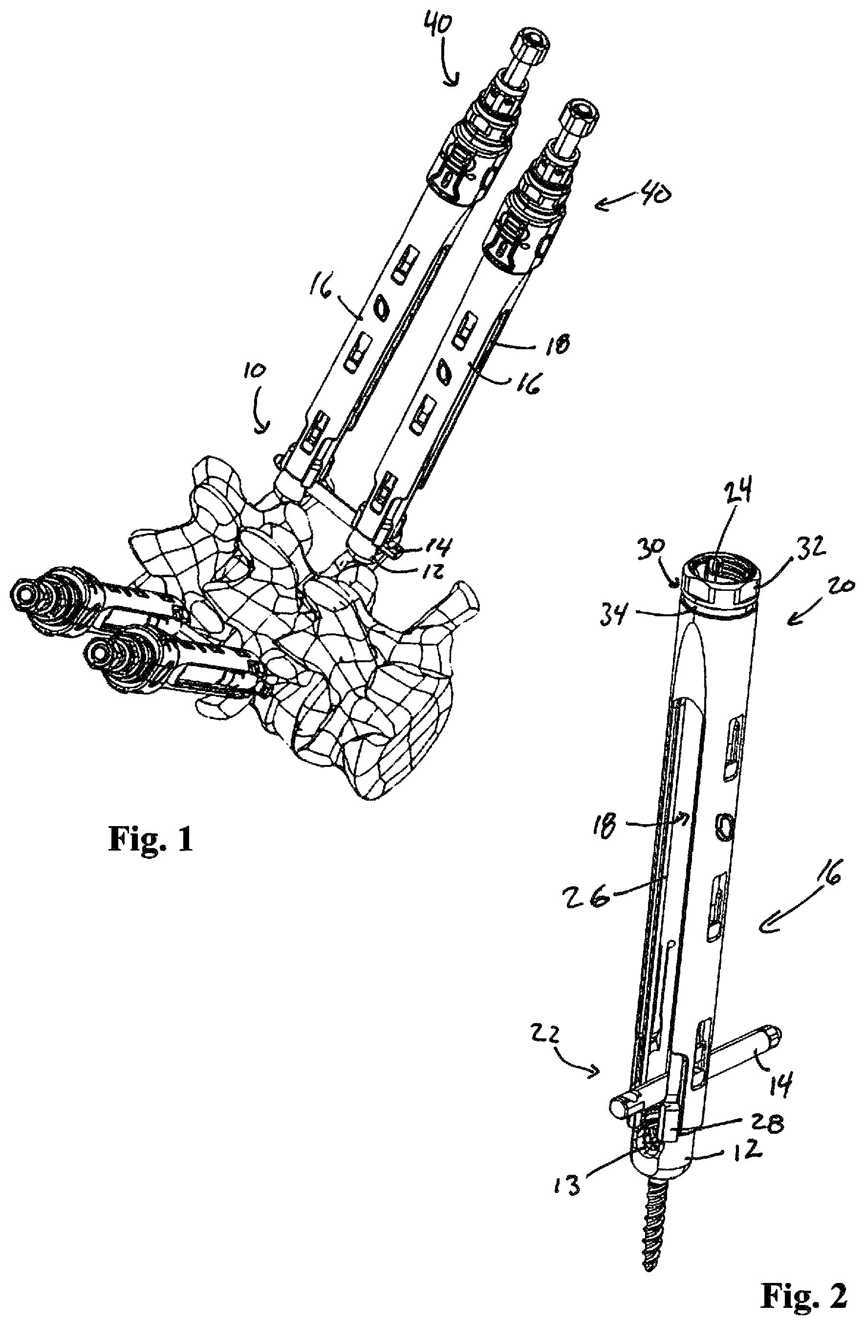 Patent US12324611 — Spinal fixation system — Figure 1